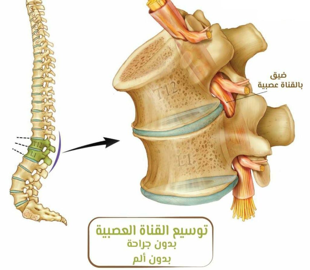 أعراض ضيق القناة العنقية في الرقبة