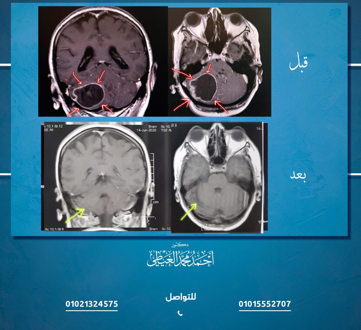 استئصال ورم خبيث بالمخيخ