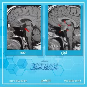 (الصور توضح رنين مغناطيسي على المخ للمريضة قبل استئصال الورم وبعد استئصال الورم كاملا) تمكن د. أحمد الغيطي والفريق المساعد من استئصال ورم بقاع الجمجمة كبير الحجم ضاغط على العصب البصري والغدة النخامية.