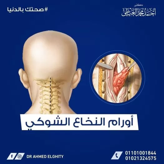 أورام النخاع الشوكي