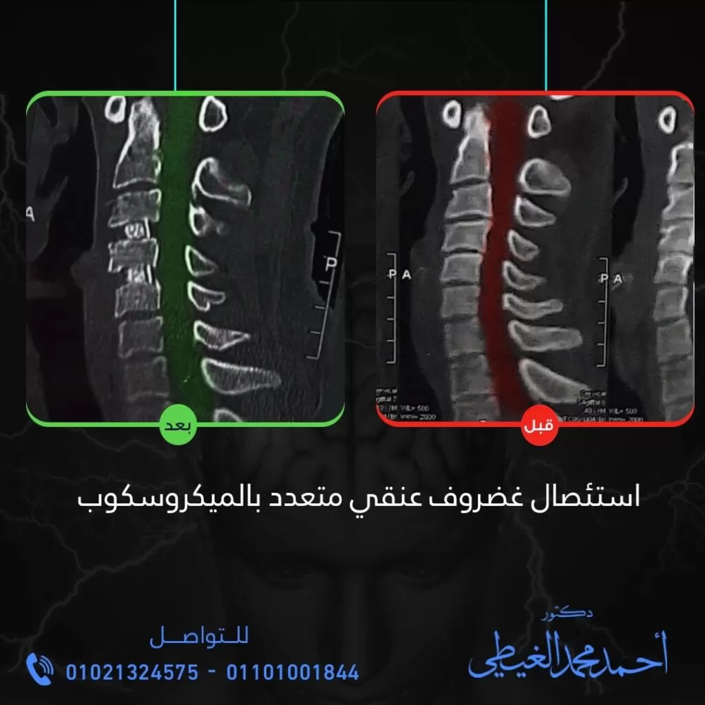 الأشعة مقطعية على فقرات الرقبة