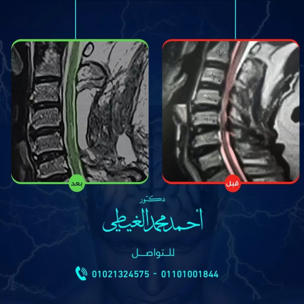 علاج اعتلال النخاع الشوكي