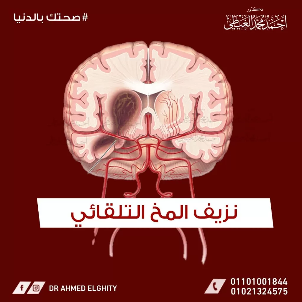 نزيف المخ الداخلي