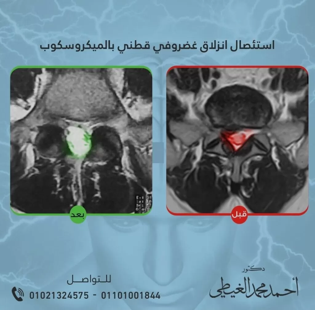 استئصال انزلاق الغضروف القطني بالميكروسكوب