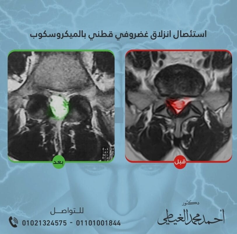 استئصال انزلاق الغضروف القطني بالميكروسكوب