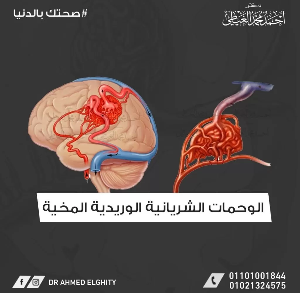 التشوه الشرياني الوريدي المخي