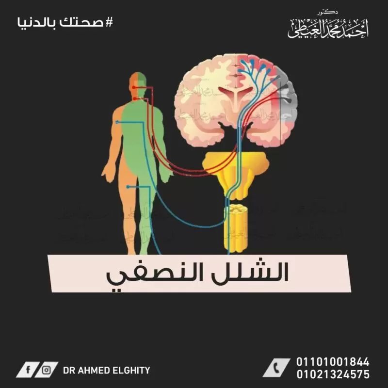 الشلل النصفي