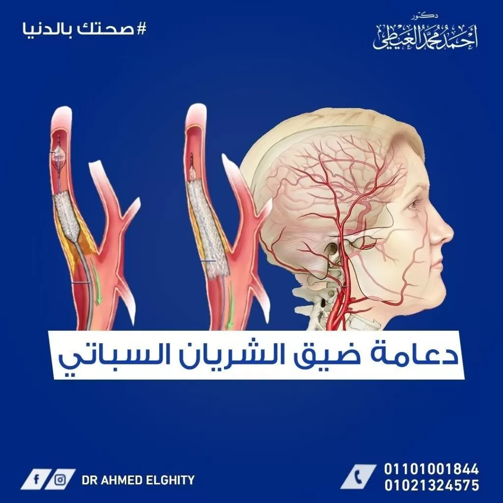 دعامة ضيق الشريان السباتي