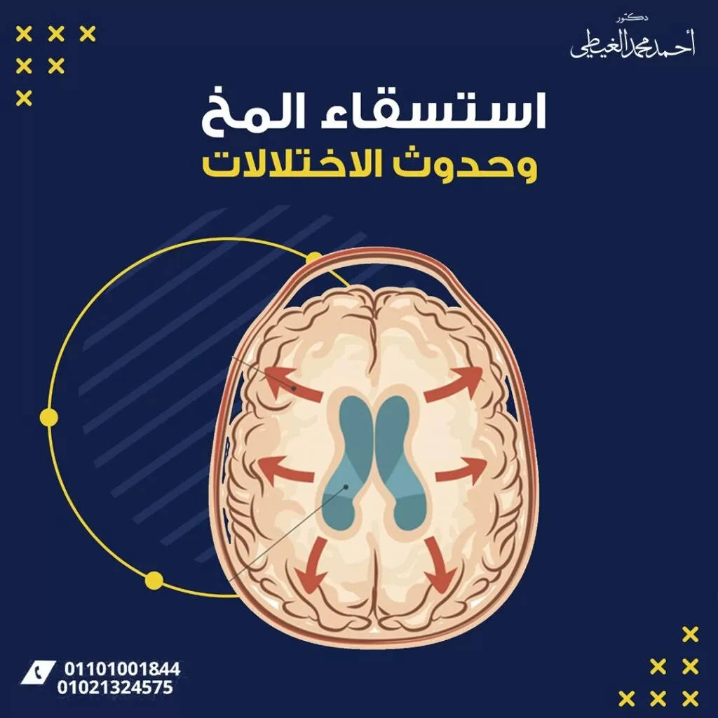 استسقاء بطينات المخ