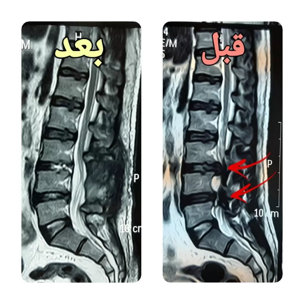 الانزلاق الغضروفي القطني المتعدد الانزلاق الغضروفي القطني انزلاق غضروفي قطني غضروف قطني اعراض غضروف القطنية غضروف القطنية ما هو الانزلاق الغضروفي القطني ما هو الغضروف القطني آلام الانزلاق الغضروفي القطني علاج انزلاق غضروفي قطني عملية الغضروف القطني غضروف الفقرات القطنية اعراض الانزلاق الغضروفي في الفقرات القطنية الانزلاق الغضروفي القطني وكمال الاجسام تمارين الغضروف القطني جراحة الغضروف القطني علاج غضروف الفقرات القطنية اعراض الانزلاق الغضروفي للفقرات القطنية اعراض غضروف الفقرات القطنية افضل علاج للانزلاق الغضروفي القطني الانزلاق الغضروفي القطني والجماع التهاب الغضروف القطني العلاج الطبيعي للإنزلاق الغضروفي القطني العلاج الطبيعي للانزلاق الغضروفي القطني انتفاخ الغضروف القطني انزلاق غضروفي في الفقرات القطنية