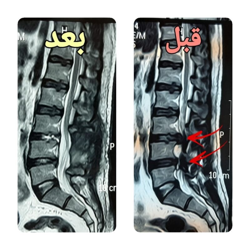 الانزلاق الغضروفي المتعدد