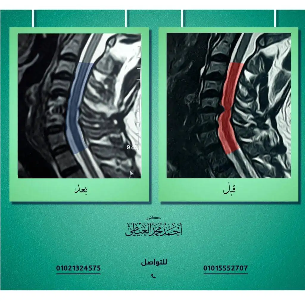 استئصال الانزلاق الغضروفي العنقي ميكروسكوبيا