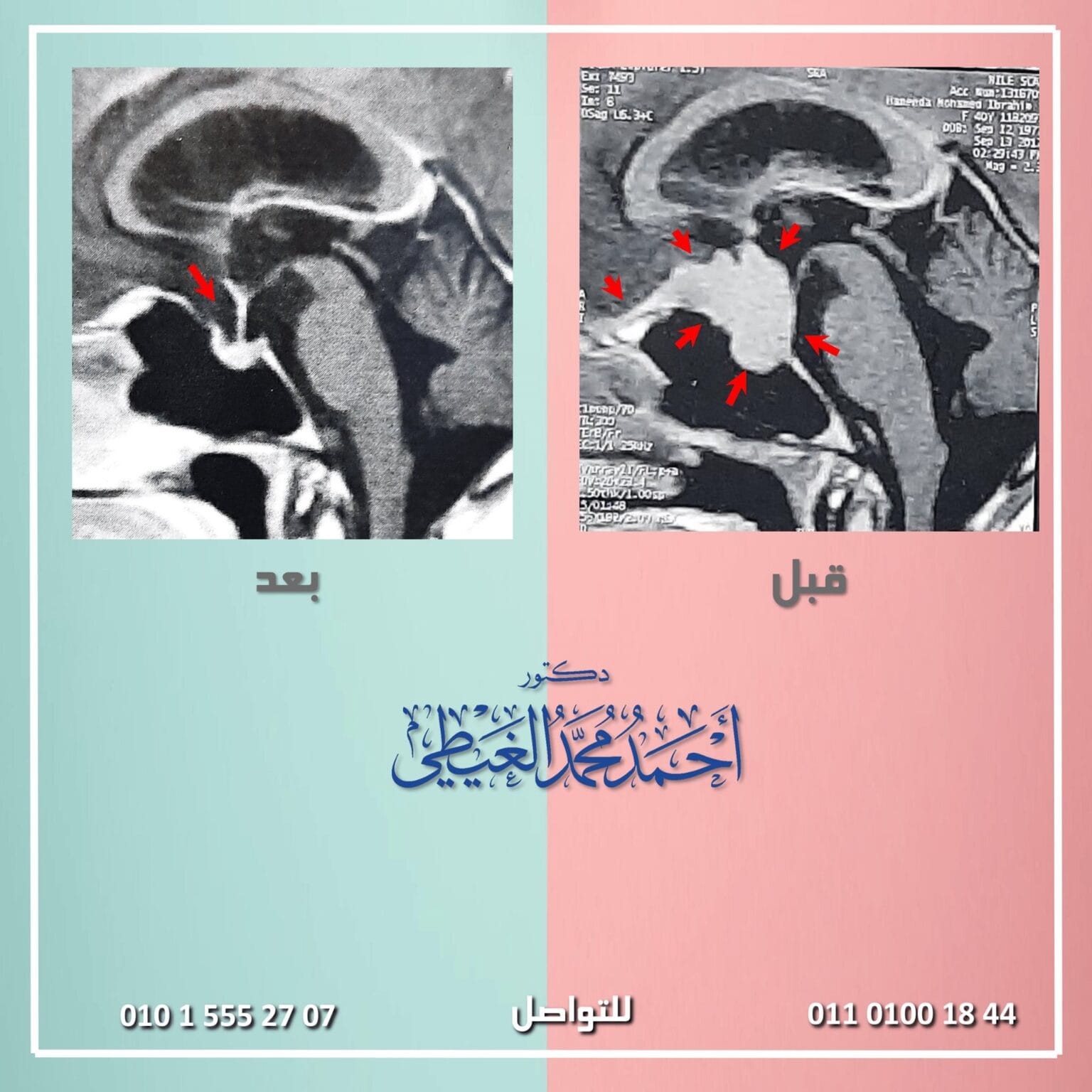 استئصال ورم بقاع الجمجمة بالميكروسكوب