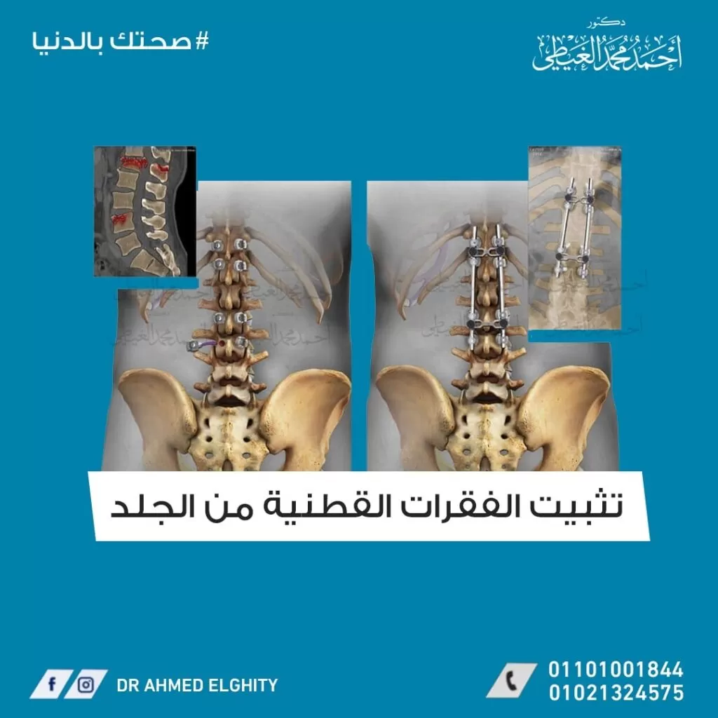 تثبيت الفقرات القطنية من الجلد