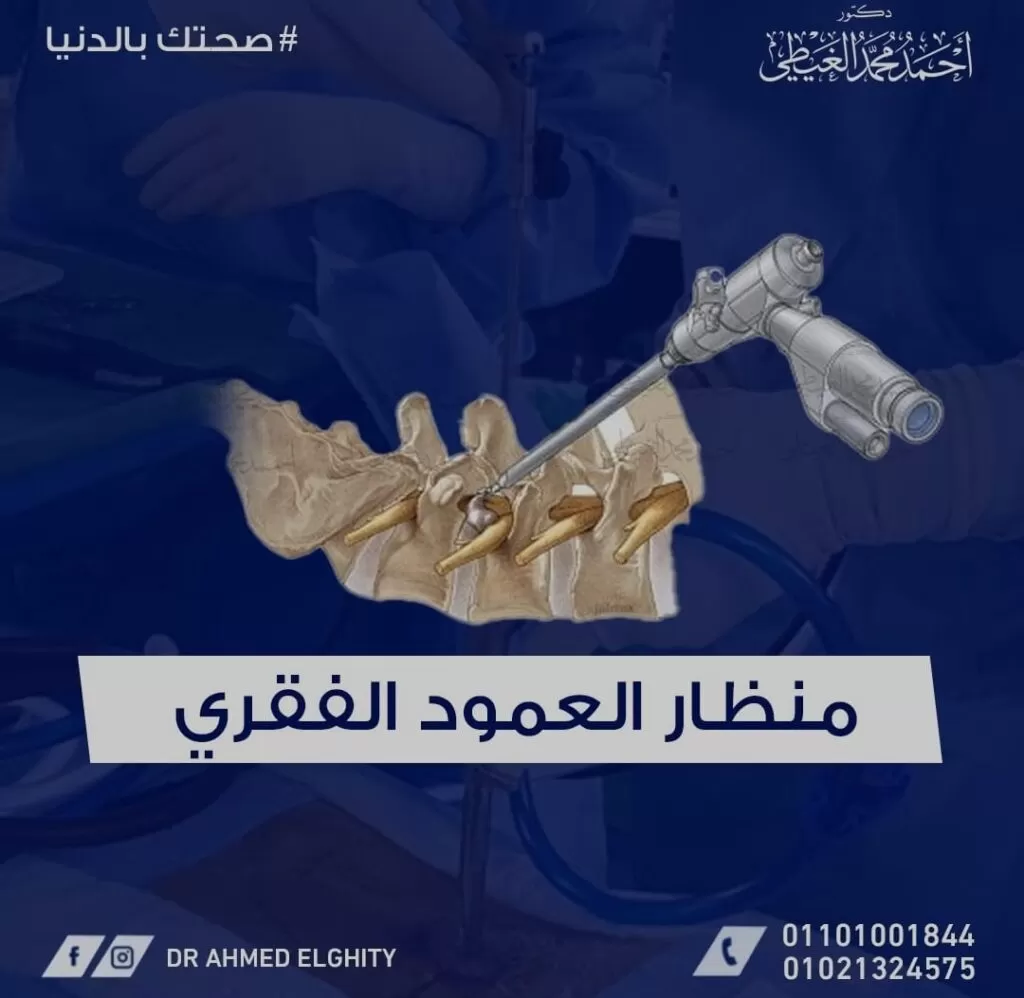 استئصال الانزلاق الغضروفي بالمنظار