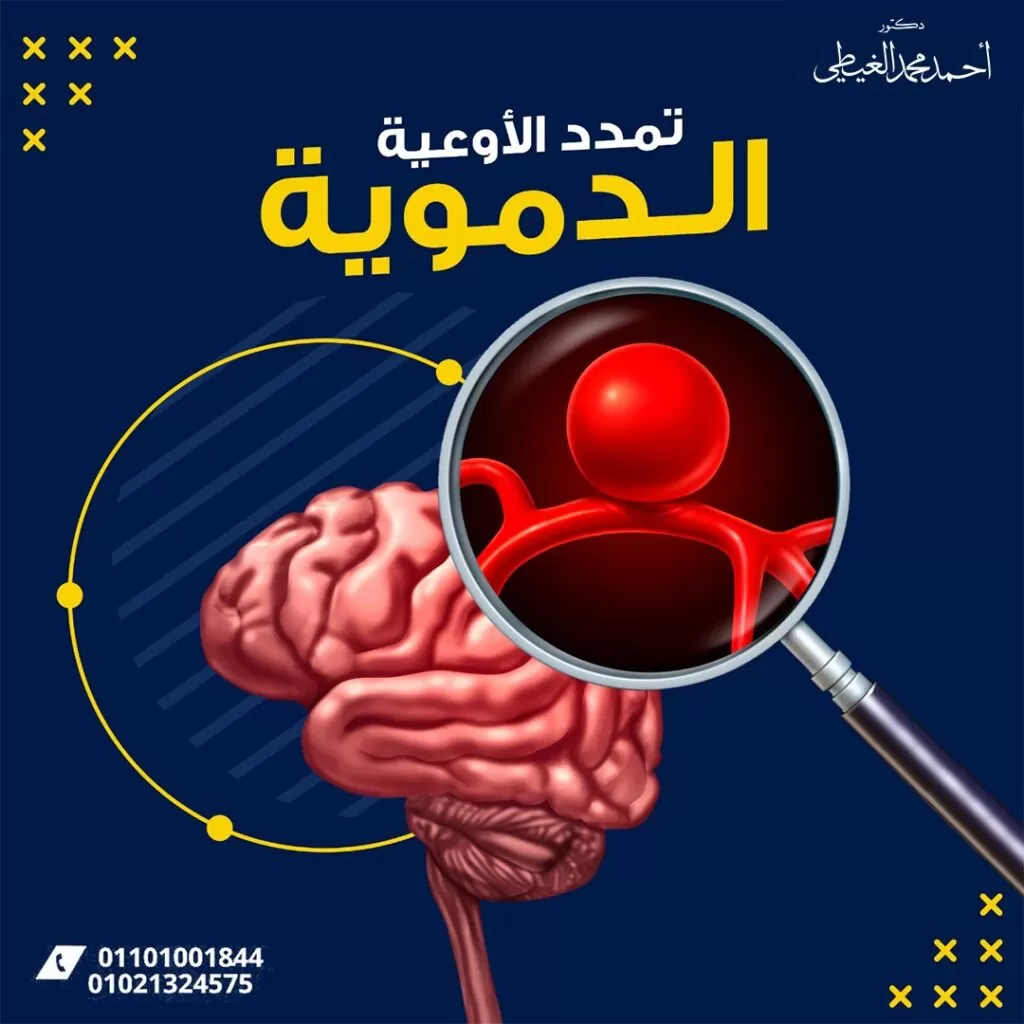 تمدد الأوعية الدموية المخية