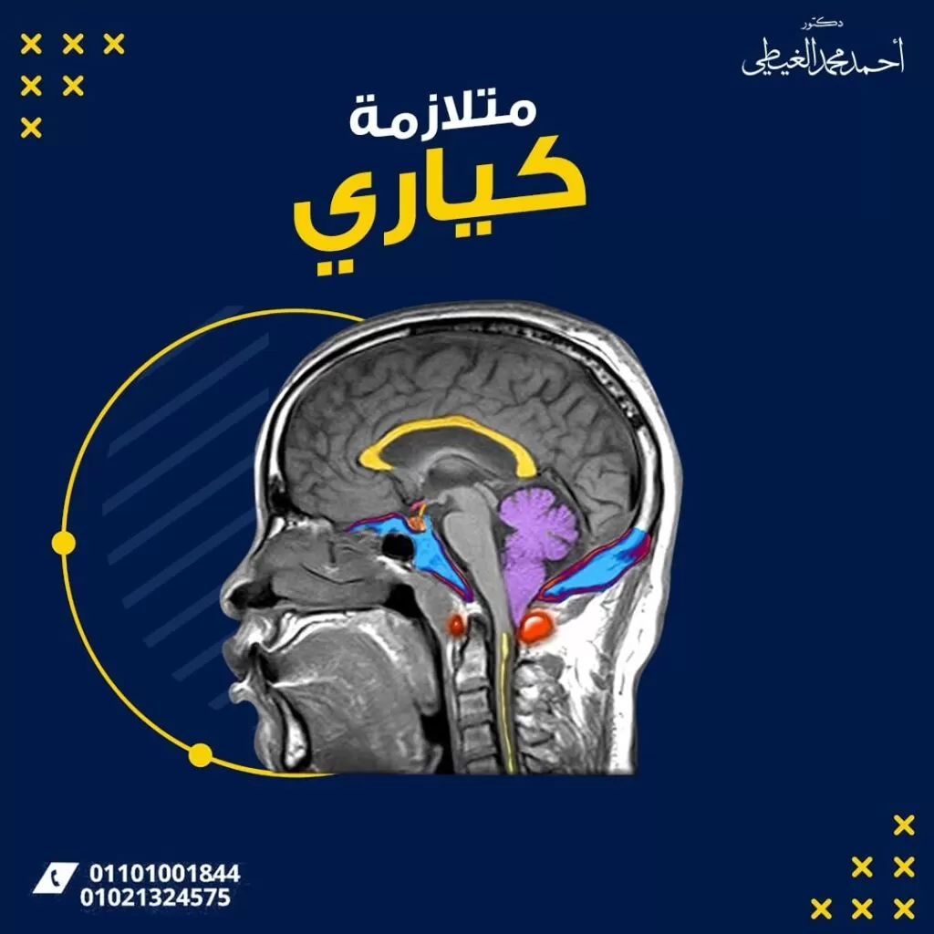 متلازمة كياري