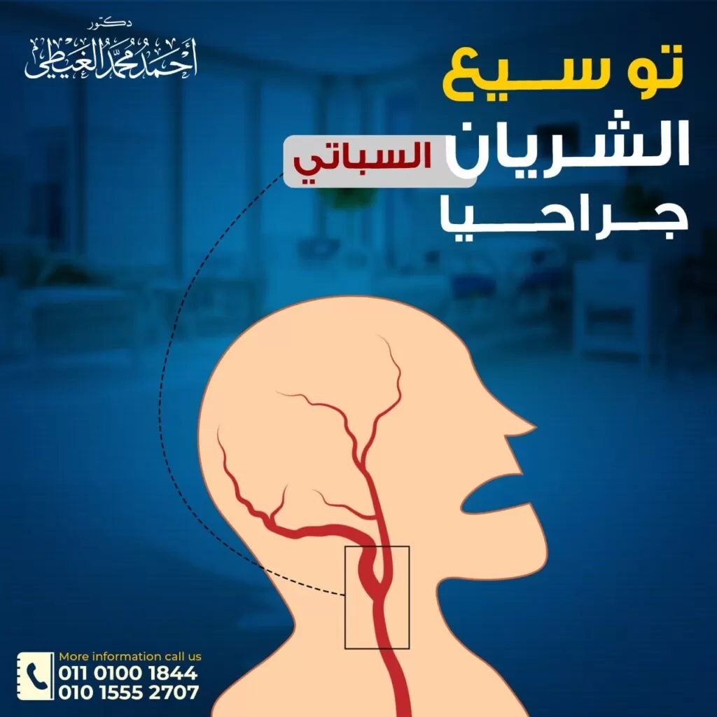 توسيع الشريان السباتي جراحيا