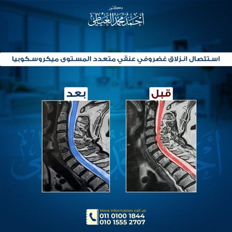 استئصال انزلاق غضروف عنقي ميكروسكوبيا