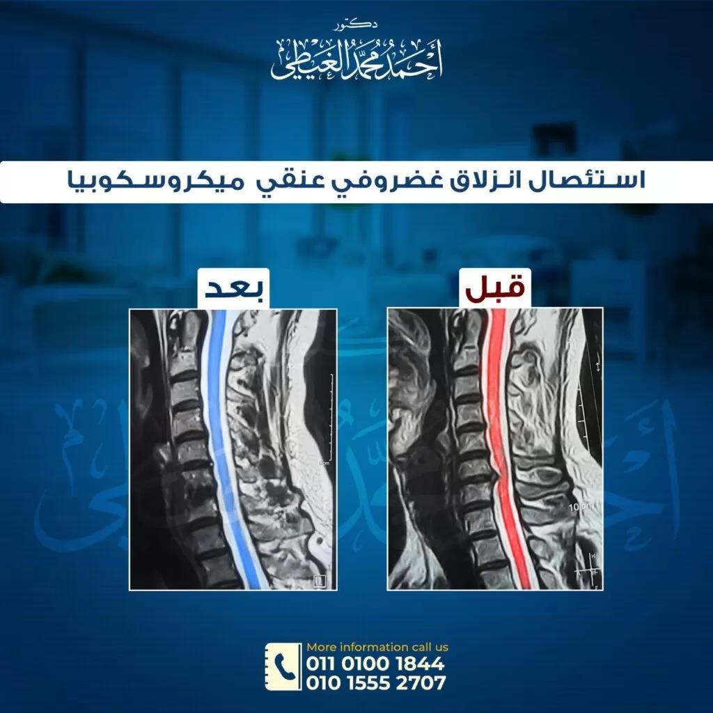 إرشادات بعد استئصال الانزلاق الغضروفي العنقي بالميكروسكوب الجراحي