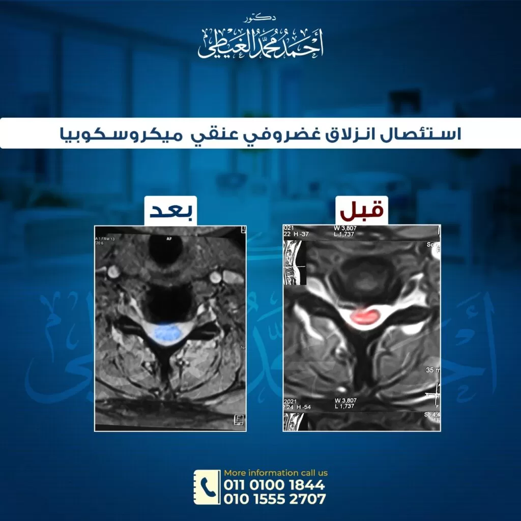 استئصال القرص المنفتق عبر الجلد