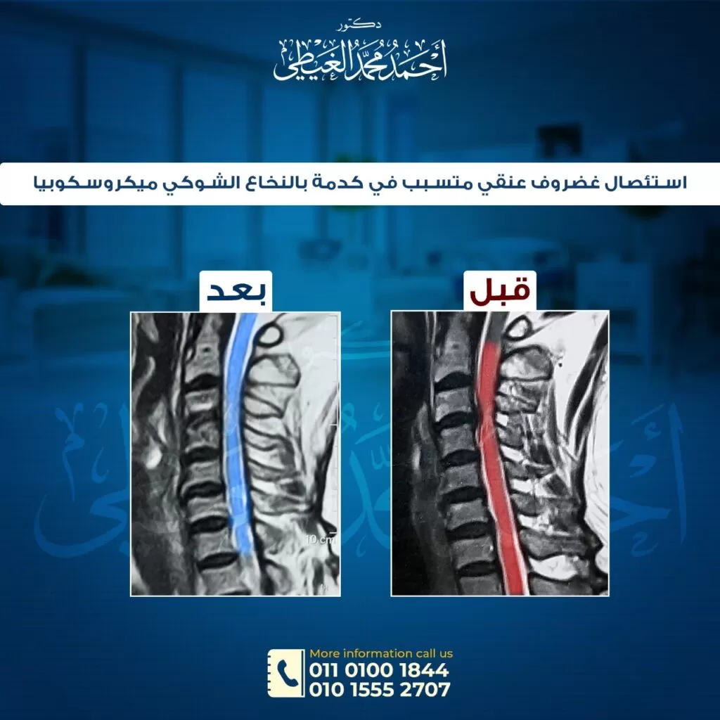 ما هي أسباب الانزلاق الغضروفي العنقي؟