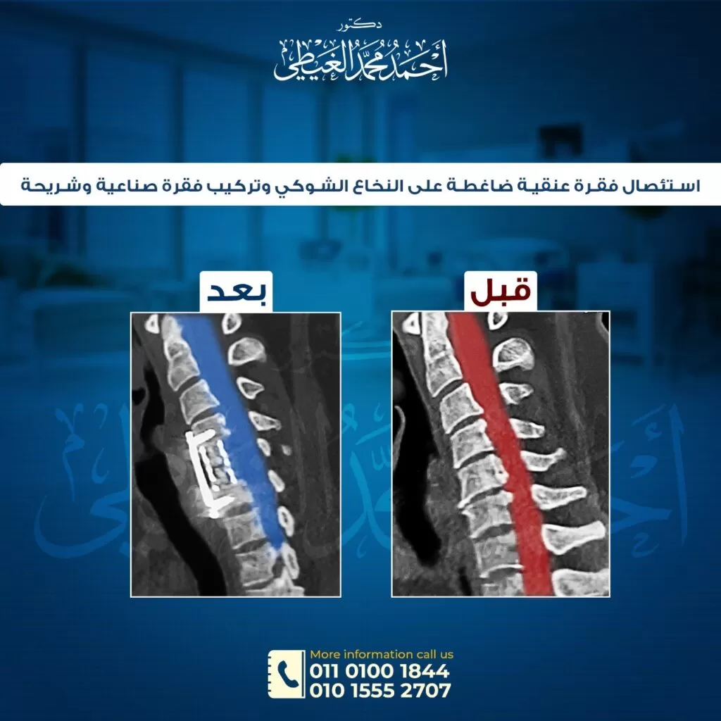 ما هو الانزلاق الغضروفي العنقي (غضروف الرقبة)و اسبابه من دكتور احمد الغيطي ما هو الانزلاق الغضروفي العنقي (غضروف الرقبة)و اسبابه من دكتور احمد الغيطي