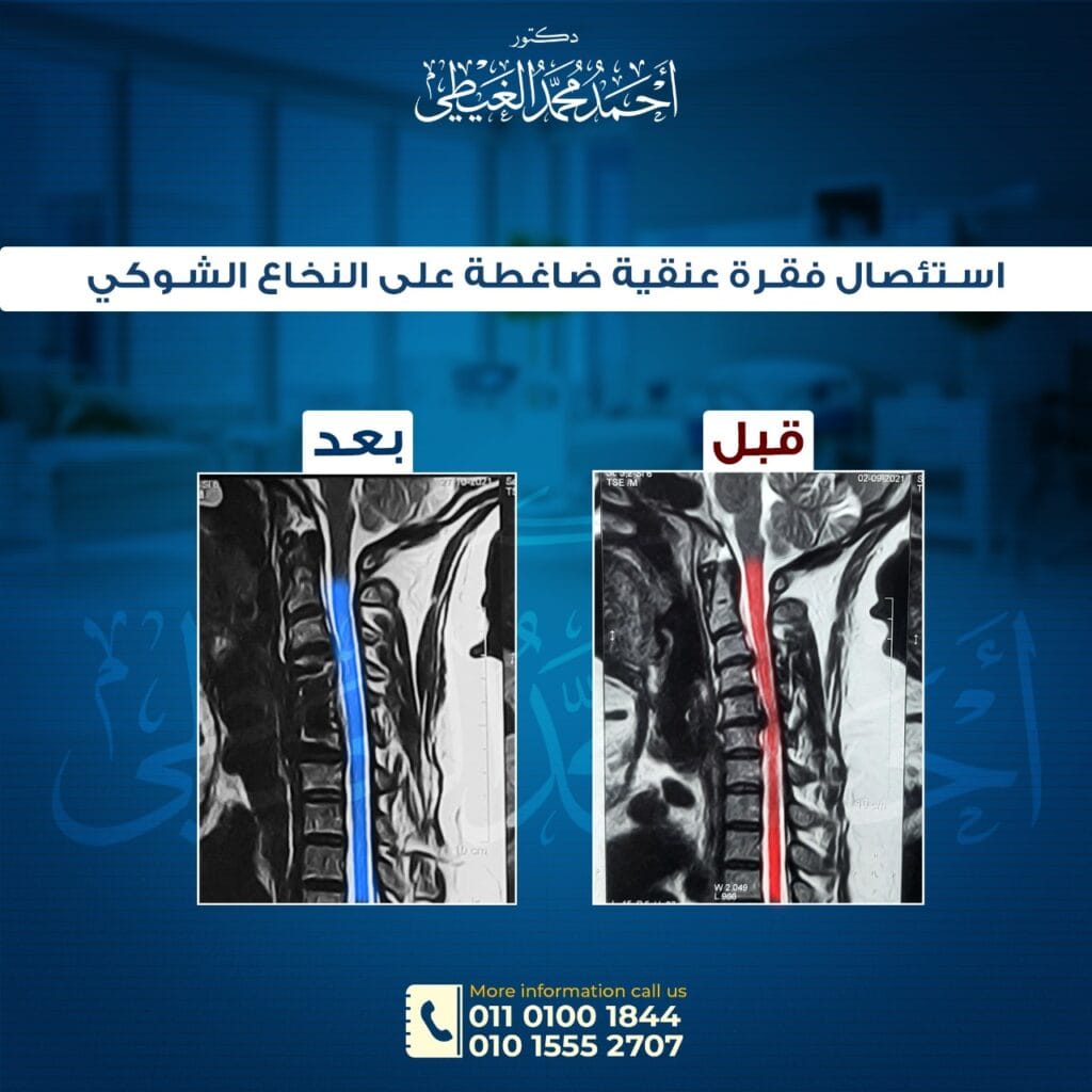 ما هو الانزلاق الغضروفي العنقي (غضروف الرقبة)؟ ما أسبابه؟ أعراضه؟ وطرق علاجة؟ وهل الميكروسكوب أفضل أم المنظار؟ دكتور أحمد الغيطي يجيب