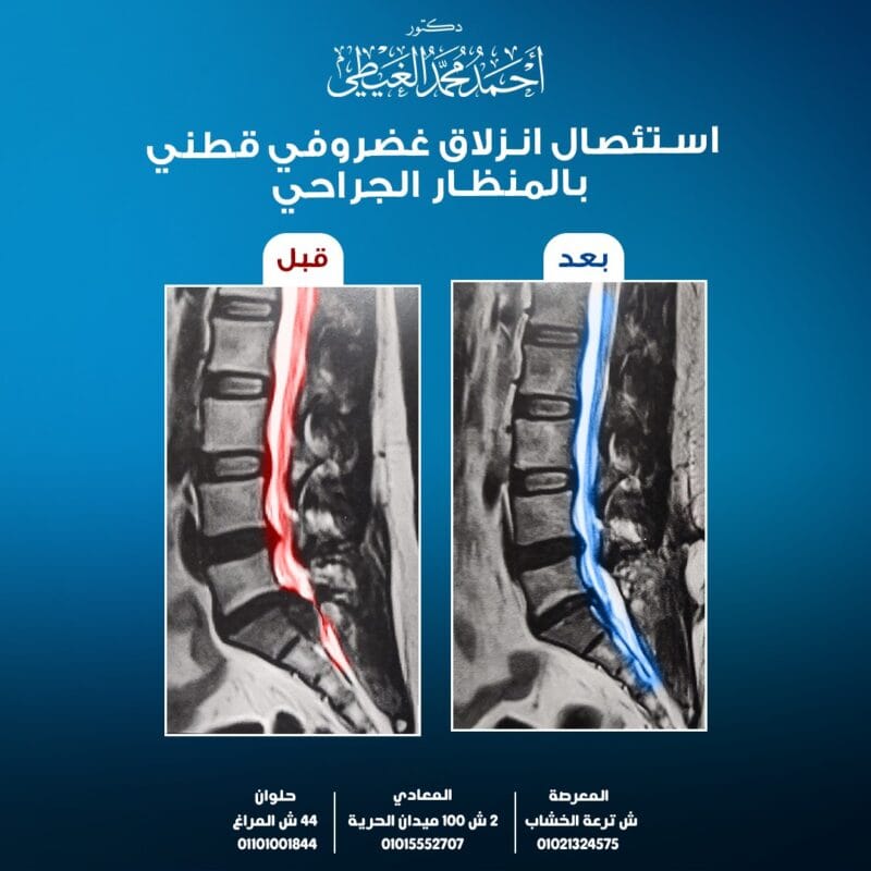 استئصال غضروف قطني منفجر بالميكروسكوب