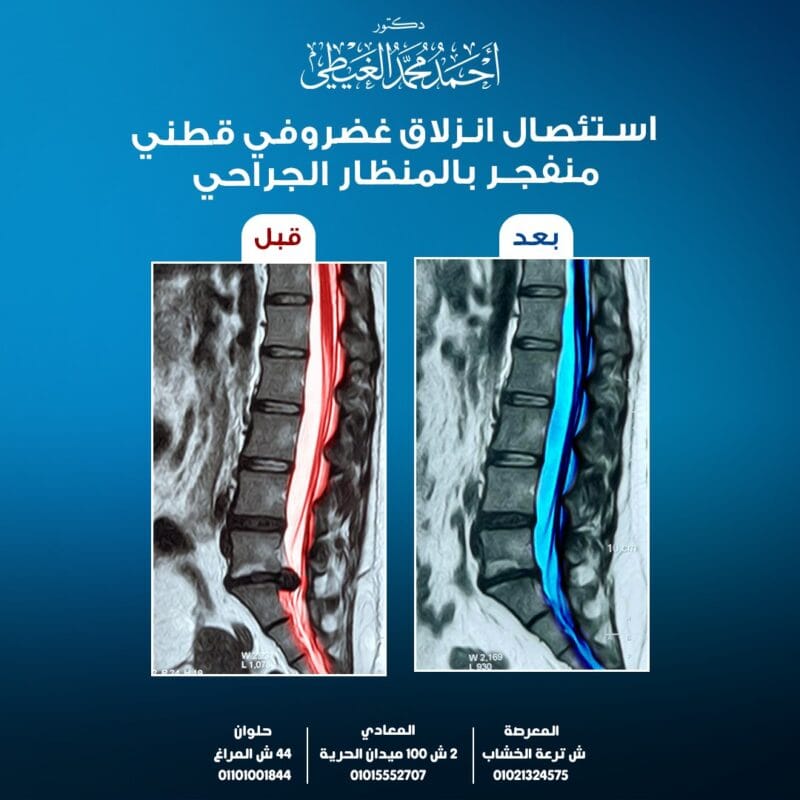 استئصال انزلاق غضروفي قني بالمنظار