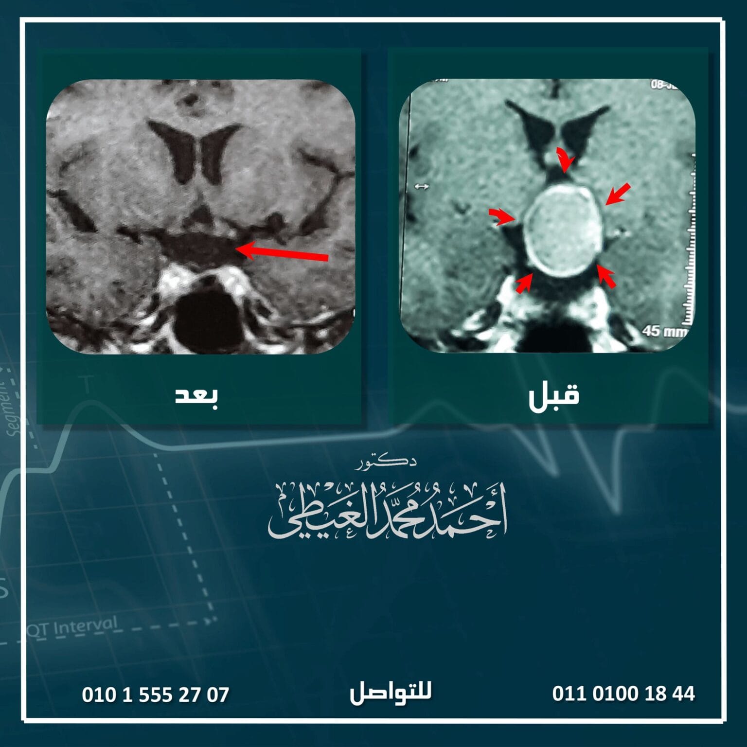 استئصال ورم بقاع الجمجمة بالمنظار