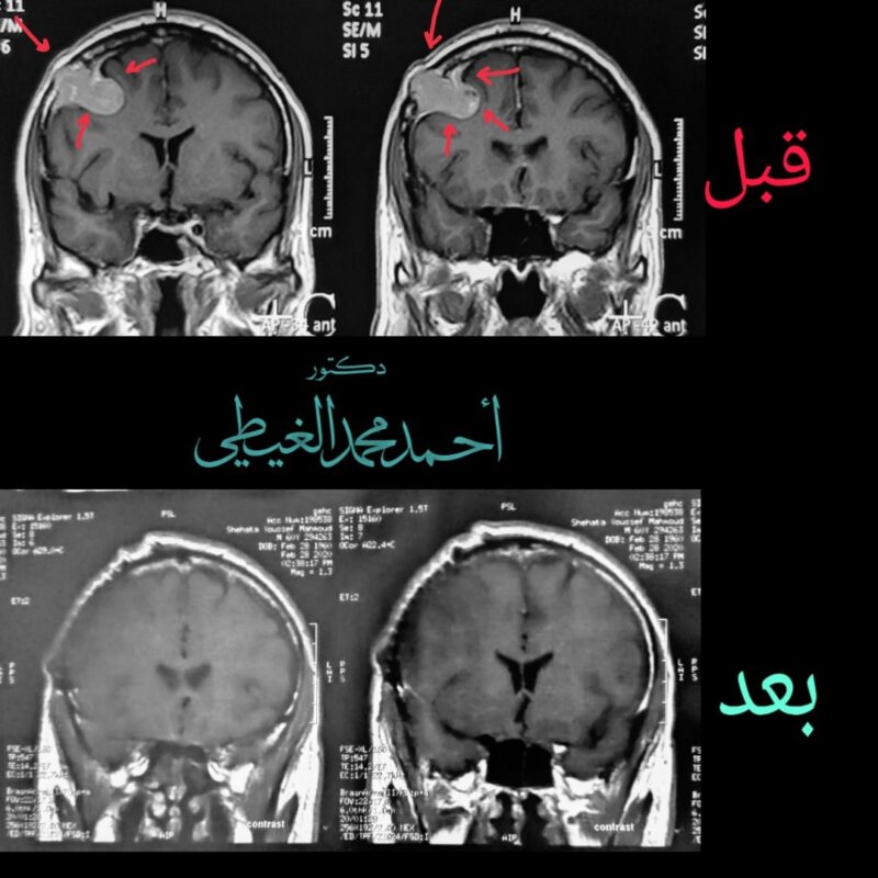 جراحة منظار قاع الجمجمة لعلاج أعراض ورم المخ المبكر