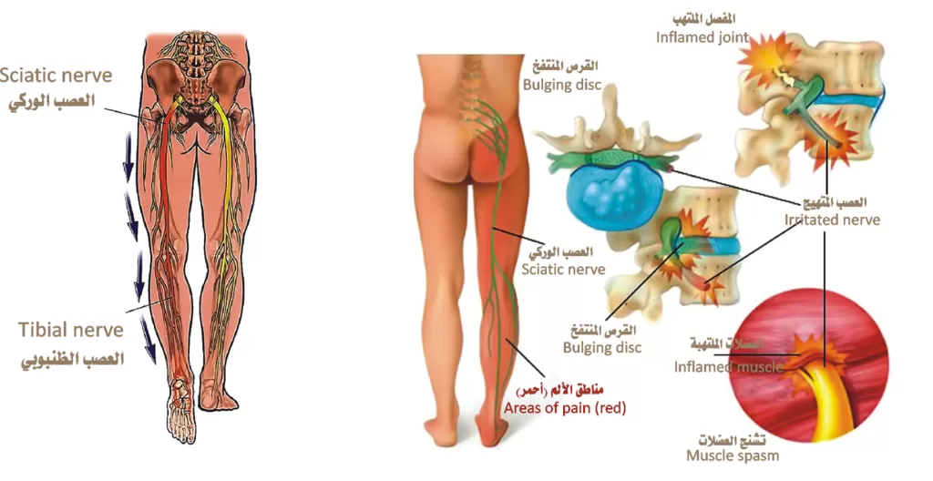علاج عرق النسا