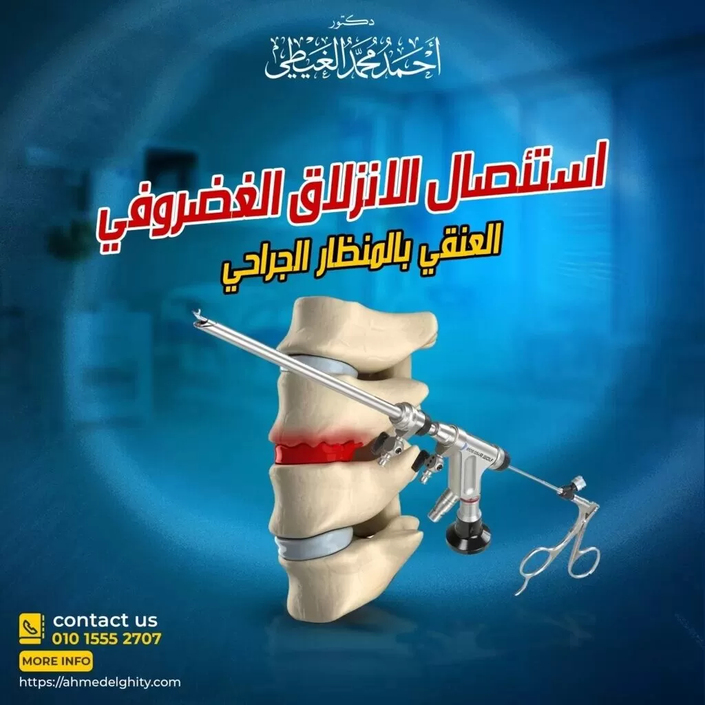 غضروف الرقبة بالمنظار