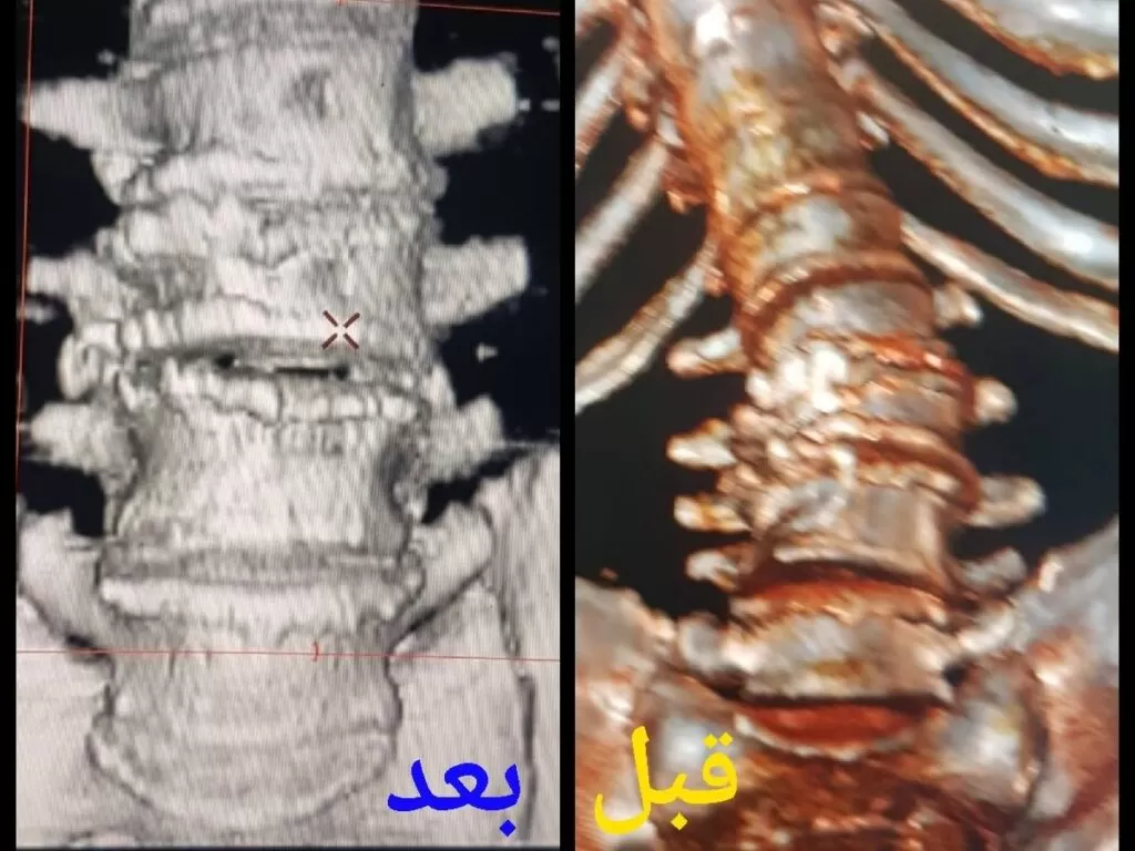 الجنف - الانحناء