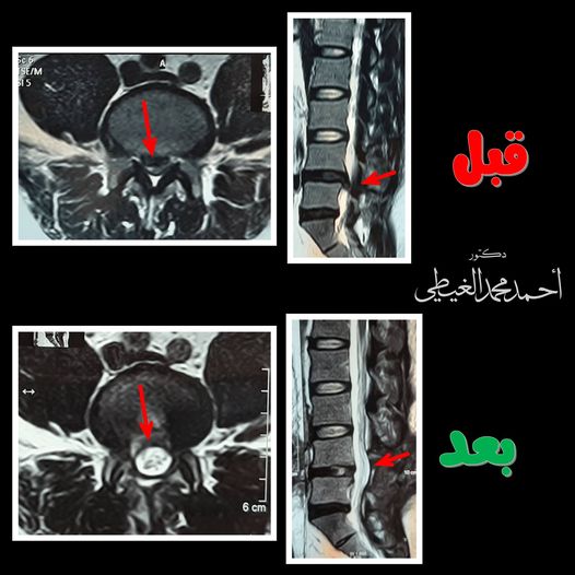 الانزلاق الغضروفي (الديسك)