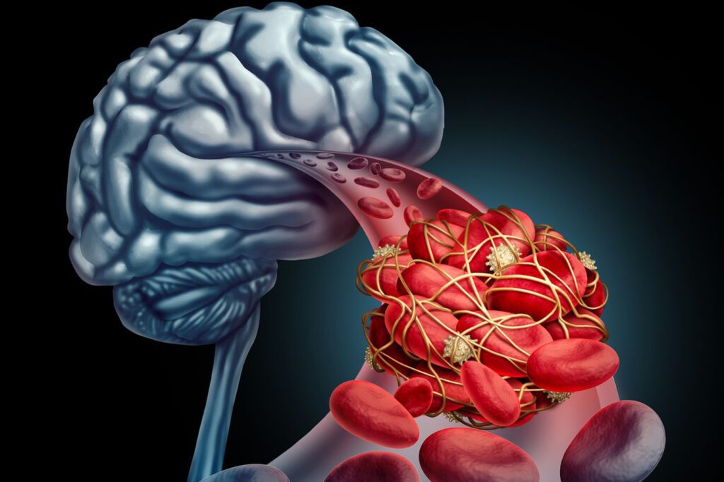 علاج جلطة المخ الغير نازفة بالجراحة