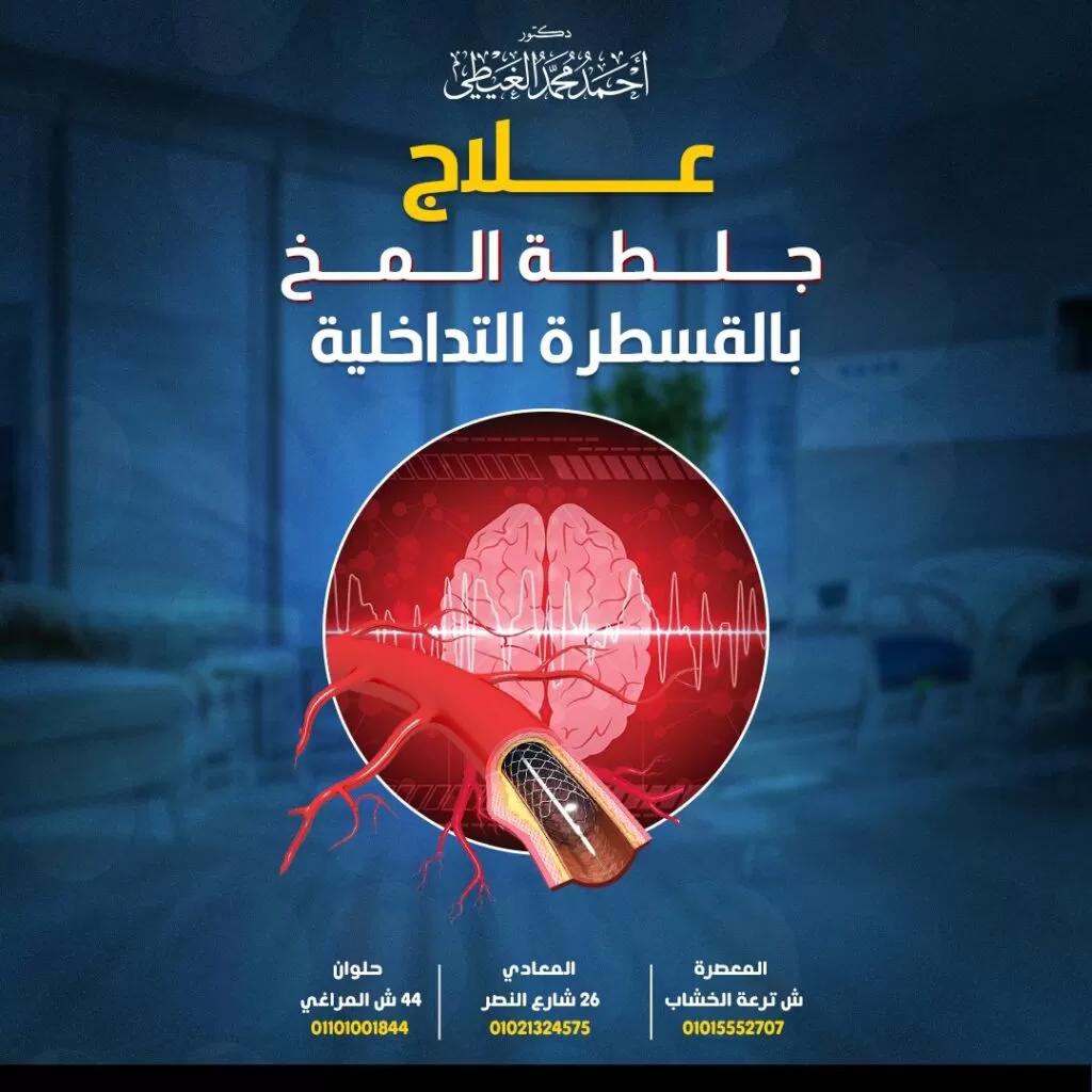 علاج جلطة المخ بالقسطرة المخية