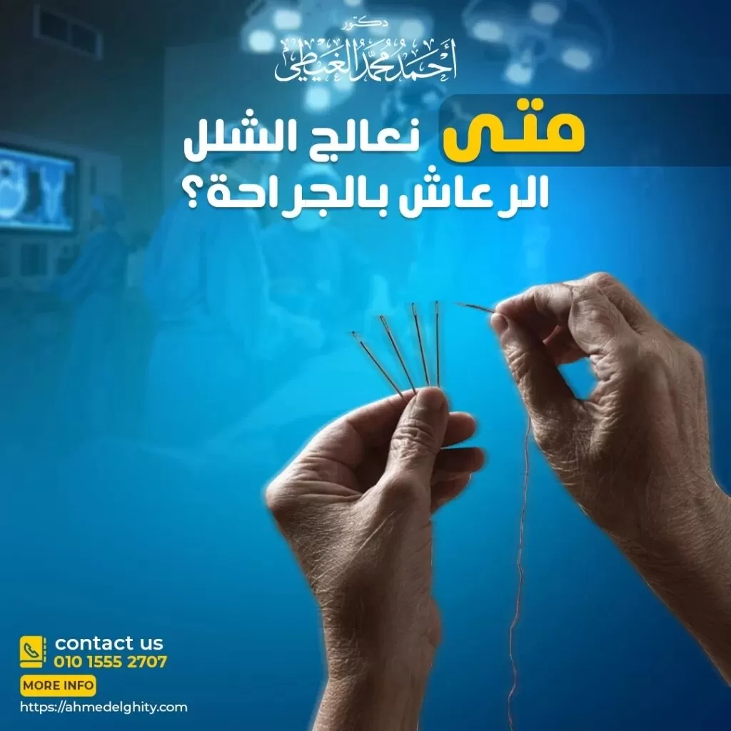 متى يكون شلل الوجه خطير؟