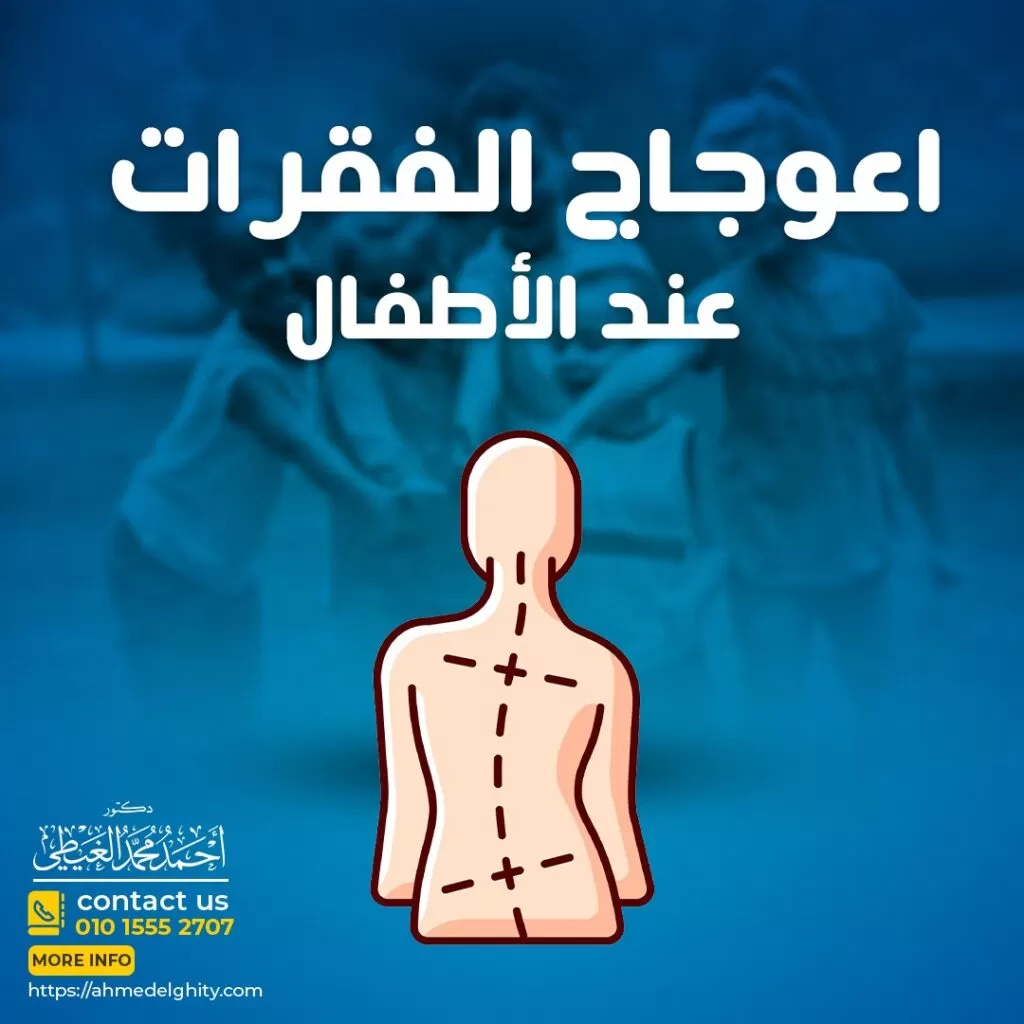 اعوجاج العمود الفقري عند الأطفال يمكن أن يظهر اعوجاج العمود الفقري عند الأشخاص في أي عمر ولكن غالبًا ما يبدأ عند الأطفال الذين تتراوح أعمارهم ما بين 10 و 15 عامًا. لذلك سيقوم دكتور أحمد الغيطي استشاري جراحة المخ والأعصاب والعمود الفقري في هذا المقال بالرد على كافة الأسئلة حول اعوجاج العمود الفقري عند الأطفال وما هي أسبابه وأنواعه وطرق علاج اعوجاج العمود الفقري عند الأطفال. ما المقصود باعوجاج العمود الفقري عند الأطفال؟ يقوم دكتور أحمد الغيطي استشاري جراحة المخ والأعصاب والعمود الفقري بتعريف الجنف (Scoliosis) على أنه انحناء غير طبيعي (انحناء جانبي) في العمود الفقري حيث يظهر العمود الفقري لدى الطفل منحنى في الجزء العلوي من الكتف ومنحنى في أسفل الظهر (يأخذ شكل حرف S أو C). ووفقًا للجمعية الأمريكية لجراحي الأعصاب (AANS) ، فإن حوالي 80 % من حالات الجنف ليس لها سبب محدد. وغالبًا ما يتم تشخيص اعوجاج العمود الفقري عند الأطفال خلال 7 سنوات الأولى من عمر الطفل. ما هي أسباب اعوجاج العمود الفقري عند الأطفال؟ تشمل الأسباب الشائعة ما يلي العيوب الخلقية العيوب الخلقية التي تؤثر على عظام العمود الفقري للرضيع مثل السنسنة المشقوقة. الشلل الدماغي وهو عبارة عن مجموعة من اضطرابات الجهاز العصبي التي تؤثر على الحركة والتعلم والسمع والرؤية والتفكير لدى الطفل. الحثل العضلي هو عبارة عن مجموعة من الاضطرابات الوراثية التي تسبب ضعف العضلات التشوهات العصبية العوامل الوراثية الأشخاص الذين يمتلكون تاريخ عائلي من الإصابة بالجنف هم أكثر عرضة للإصابة. إصابات العمود الفقري. ما هي أنواع اعوجاج العمود الفقري (الجنف) الشائعة عند الأطفال؟ الجنف مجهول السبب هو أكثر أنواع اعوجاج العمود الفقري شيوعاً عند الأطفال (ما يصل إلى 80% من عدد حالات الجنف)حيث لا يوجد سبب محدد للإصابة بهذا النوع ، ويتم تقسيم الجنف مجهول السبب حسب الفئة العمرية كما يلي الرضيع من 0 إلى 3 سنوات الصغار من 4 إلى 10 سنوات المراهقون من 11 إلى 18 عامًا الكبار فوق عمر 18سنة اعوجاج العمود الفقري (الجنف) الخلقي عند الأطفال يظهر الجنف الخلقي عند ولادة الطفل نتيجة لوجود بعض المشاكل في الفقرات (أثناء نمو الجنين) حيث قد تكون غير مكتملة أو لاتنقسم بشكل صحيح. الجنف العصبي العضلي يحدث عندما تؤثر تشوهات الأعصاب على عضلات العمود الفقري مثل الشلل الدماغي أو مرض السنسنة المشقوقة. تتسبب هذه الحالات المرضية في إتلاف العضلات مما يؤدي إلى اعوجاج العمود الفقري لعدم دعمه بشكل صحيح من خلال العضلات. الجنف التنكسي يصيب البالغين ويتطور عادة في منطقة أسفل الظهر نتيجة تآكل أقراص ومفاصل العمود الفقري مع تقدم العمر. أعراض اعوجاج العمود الفقري عند الأطفال تختلف الأعراض حسب درجة الجنف. وتشمل الأعراض الشائعة المصاحبة للجنف ما يلي ظهور كتف واحدة أعلى من الكتف الأخرى. بروز خلفي لكتف واحد أكثر من الآخر. أيضا بروز بعض الضلوع على جانب واحد من الجسم أكثر من الجانب الآخر. مشاكل في التنفس بسبب وجود ضيق في منطقة الصدر, حيث أن اعوجاج العمود الفقري عند الأطفال يضغط على الرئة. عدم ارتكاز رأس الطفل في منتصف جسمه. المشي الغير متزن السير بميل إلى ناحية آلام في الظهر. صعوبة في المشي والحركة. أنواع اعوجاج العمود الفقري عند الأطفال (جنبف الأطفال) يمكن تقسيم الجنف إلى فئتين الجنف الهيكلي والجنف غير الهيكلي. الجنف غير الهيكلي (Non structural scoliosis) يعمل العمود الفقري بشكل طبيعي ولكنه يظهر منحنياً ويرجع ذلك لعدة أسباب مثل وجود ساق أطول من الساق الأخرى، التشنجات العضلية، وتقلصات عضلات العمود الفقري بعض الالتهابات مثل التهاب الزائدة الدودية. وعندما يتم علاج هذه المشاكل غالباً ما يزول الجنف. الجنف الهيكلي (Structural scoliosis) يكون الانحناء في العمود الفقري صلب ومتيبس. يحدث لعدة أسباب مثل ضمور العضلات سواء بسبب الشلل الدماغي أو أي سبب آخر الشلل الدماغي، بعض العيوب الخلقية، الأورام، الالتهابات. كيف يتم تشخيص اعوجاج العمود الفقري عند الأطفال (الجنف)؟ الخطوة الأولى التي يتخذها الطبيب للتشخيص هي معرفة التاريخ الطبي لحالة الطفل ثم يبدأ في الفحص البدني للعمود الفقري. إجراء بعض الاختبارات البدنية مثل يراقب الطبيب ظهر الطفل أثناء وقوفه واضعاً ذراعيه على جانبيه للتحقق من انحناء العمود الفقري وما إذا كانت منطقة الكتفين والخصر متناسقة. بعد ذلك يطلب الطبيب أن ينحني الطفل للأمام مع إرخاء ذراعيه للكشف عن أي انحناء في أعلى وأسفل الظهر وللكشف أيضاً عن أي بروز في القفص الصدري. إجراء الفحص العصبي للطفل للتأكد من وجود ضعف العضلات أو الخدر أو ردة فعل غير طبيعي. التصوير بالأشعة السينية أثناء هذا الاختبار ، تُستخدم كميات صغيرة من الإشعاع لتكوين صورة للعمود الفقري. التصوير بالرنين المغناطيسي يستخدم هذا الاختبار للحصول على صورة مفصلة للعظام والأنسجة المحيطة بها. التصوير بالأشعة المقطعية خلال هذا الاختبار ، يتم أخذ مجموعة متنوعة من الزوايا للحصول على صورة ثلاثية الأبعاد للجسم لقياس درجة اعوجاج العمود الفقري (Cobb Method). فحص العظام يتم حقن محلول مشع في الدم ويتركز في مناطق زيادة الدورة الدموية ، مما يبين تشوهات العمود الفقري . علاج اعوجاج العمود الفقري عند الأطفال يعتمد العلاج على عدة عوامل منها درجة اعوجاج العمود الفقري هي عامل رئيسي ويأخذ الطبيب في الاعتبار أيضًا عمر الطفل وحالته الصحية. ما إذا كان من المحتمل أن يستمر في النمو وزيادة الطول. مقدار ونوع الاعوجاج لا يحتاج الأطفال الذين لديهم اعوجاج طفيف في العمود الفقري إلى تلقي أي علاج ولكن لابد من خضوعهم لفحص دوري بصورة منتظمة لتحديد ما إذا كان الاعوجاج يزداد مع نمو الطفل أم لا. نوع الجنف الدعامات لعلاج اعوجاج العمود الفقري عند الأطفال يكون استخدام دعامة العمود الفقري أكثر فاعلية للحالات التي يتم اكتشافها مبكرًا والأطفال الصغار حيث يحتاج الطفل المصاب بالجنف إلى استخدام دعامة إذا كان لا يزال في مرحلة النمو وكان الانحناء أكثر من 25 إلى 40 درجة. لن تعمل الدعامات على تقويم العمود الفقري و لكن يمكنها أن تمنع زيادة الاعوجاج، يتم تفصيل الدعامات حسب حجم الطفل ودرجة الاعوجاج. ما المدة التي يحتاج فيها الطفل ارتداء دعامة الظهر؟ في الغالب يتم ارتداء الدعامة لمدة ما بين 13 إلى 16 ساعة في اليوم حتى الوصول إلى عمر البلوغ (التوقف عن النمو) وتزداد فاعلية الدعامة مع زيادة عدد الساعات التي يرتديها الطفل يوميًا. ما هي أنواع دعامات تقويم العمود الفقري لدى الأطفال؟ هناك نوعان رئيسيان من دعامات تقويم العمود الفقري دعامة تحت الإبط وهي دعامة مصنوعة من البلاستيك ومناسبة لشكل الجسم ، وهي غير مرئية تقريبًا يتم ارتدائها تحت الملابس وتستخدم في علاج منحنيات العمود الفقري السفلية ويتناسب مع الجزء السفلي من الجسموتتميز هذه الدعامات بعدم تأثيرها على الأنشطة اليومية للطفل. دعامة الجسم كله نوع آخر من الدعامات وهي تبدأ من الرقبة وتغطي الجذع بأكمله، باستثناء الساقين والذراعين ويتم استخدامها للمنحنيات التي لا تستطيع دعامة الإبط معالجتها. التدخل الجراحي لعلاج اعوجاج العمود الفقري عند الأطفال عادة ما يتم اللجوء إلى الجراحة في الأطفال الذين يعانون من انحناءات تزيد عن 40 درجة. جراحة دمج الفقرات عند الأطفال هي الجراحة القياسية للجنف. في هذا الإجراء ، يقوم دكتور أحمد الغيطي استشاري جراحات العمود الفقري المتقدمة بدمج وتثبيت فقرتين أو أكثر من فقرات الظهر معًا باستخدام طُعم عظمي وقضبان ومسامير ويتكون الطعم العظمي من عظم أو مادة مثله. تحافظ القضبان المستخدمة على العمود الفقري في وضع مستقيم ، حيث تندمج الطعوم العظمية والفقرات معاً و يمكن تعديل القضبان أثناء نمو الأطفال لقدرتها على التكيف مع زيادة طول الطفل ويمكن تمديد هذه القضبان كل 3 إلى 6 أشهر. بعض مخاطر جراحة دمج الفقرات التعرض إلى النزيف. الإصابة بالعدوى. تلف أو تهتك الأعصاب. من هو أفضل دكتور مخ واعصاب لعلاج اعوجاج العمود الفقري عند الأطفال؟ أفضل وأحسن دكتور مخ وأعصاب يقوم بعلاج اعوجاج العمود الفقري عند الأطفال بالجراحة هو جراح المخ والأعصاب الذي تدرب على فروع جراحات المخ والأعصاب متناهية الدقة والميكروسكوبية, سواء باستخدام الميكروسكوب الجراحي أو باستخدام منظار العمود الفقري. كما يجب أن يكون متمكنا من دراسة التاريخ المرضي للحالة بدقة والتأكد من نوع اهوجاج العمود الفقري الموجود لدى الطفل. ويقوم دكتور أحمد الغيطي باجراء كافة جراحات اعوجاج العمود الفقري عند الأطفال سواء ميكروسكوبيا أو بالتدخل المحدود. أراء مرضى دكتور أحمد الغيطي أفضل دكتور جراحة مخ وأعصاب العمليات التي يجريها دكتور أحمد الغيطي مجموعة من صور أشعات بعض المرضى قبل وبعد اجراء تدخلات جراحية لعلاج حالتهم, قام باجراء الجراحات دكتور أحمد الغيطي. يقوم دكتور أحمد الغيطي بإجراء جراحات أورام المخ والنخاع الشوكي, أورام قاع الجمجمة, غلق التمددات الشريانية والتشوهات الشريانية الوريدية جراحيا وعن طريق القسطرة المخية التداخلية. يقوم دكتور أحمد الغيطي باجراء جراحات العمود الفقري متناهية الدقة كاستئصال الانزلاق الغضروفي العنقي والقطني بالميكروسكوب أو المنظار الجراحي. عيادة دكتور أحمد الغيطي استشاري جراحة المخ والأعصاب والعمود الفقري اقرأ أيضا (مصادر) ورم المخ الحميد اعراض ورم المخ وعلاجه ورم المخيخ فى عيادات دكتور أحمد الغيطي نحرص على اتباع الخطوات اللازمة للتعرف على حالتك وبناء خطة علاجية فعالة. اضغط هنا لحجز موعد في عيادة دكتور أحمد الغيطي لعلاج اعوجاج العمود الفقري عند الأطفال بالجراحة دكتور أحمد الغيطي استشاري جراحة المخ والأعصاب والعمود الفقري. استشاري القسطرة المخية التداخلية وجراحات المخ والأعصاب الوظيفية وجراحة الصرع. دكتوراه جراحة المخ والأعصاب – كلية طب القصر العيني – جامعة القاهرة. زميل البورد الأوربي للجراحات العصبية (FEBNS). تابعونا على صفحة الفيسبوك من هنا صفحة الفيسبوك للاستفسارات والحجز بعيادات دكتور أحمد الغيطي عيادة المعادي 26 شارع النصر أعلى فودافون ت 01021324575 وعيادة حلوان 44 شارع المراغي بجوار محطة مترو حلوان ت 01101001844 عيادة المعصرة ش ترعة الخشاب فوق كافيتيريا اللؤلؤة ت 01015552707 احجز الآن مع دكتور أحمد الغيطي من هنا