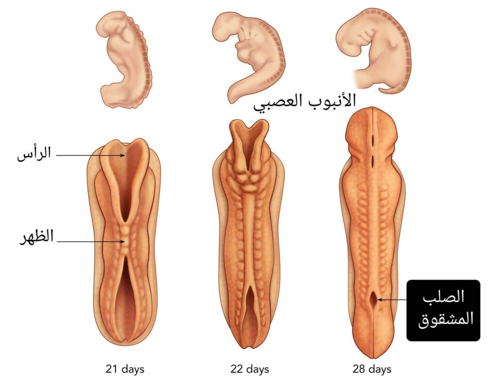 أسباب حدوث السنسنة المشقوقة