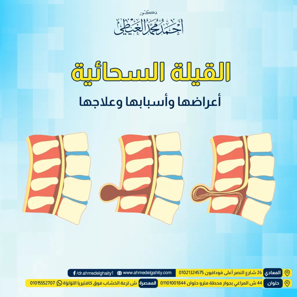 القيلة السحائية, أعراضها وأسبابها وعلاجها