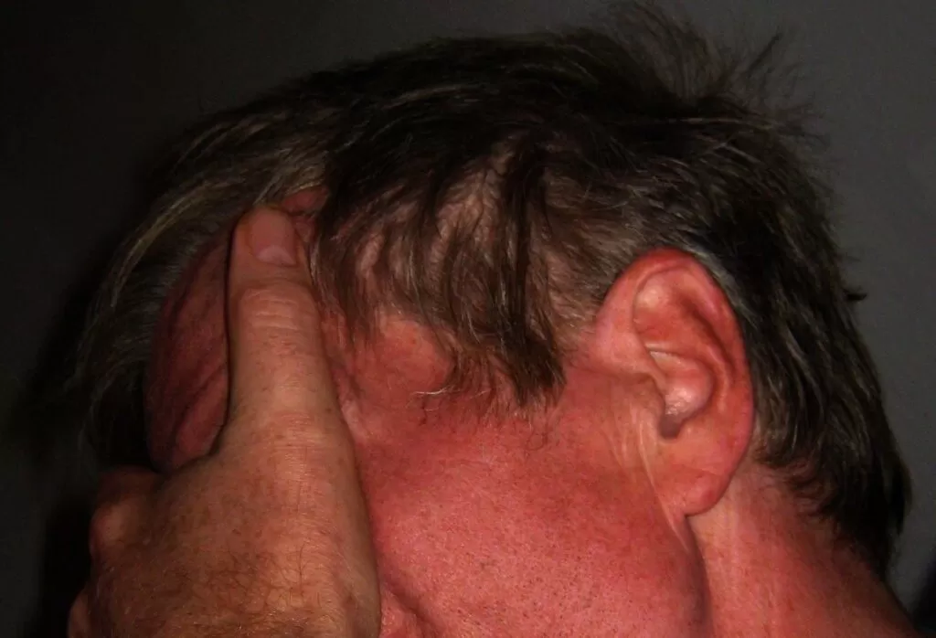 طرق علاج الشقيقة