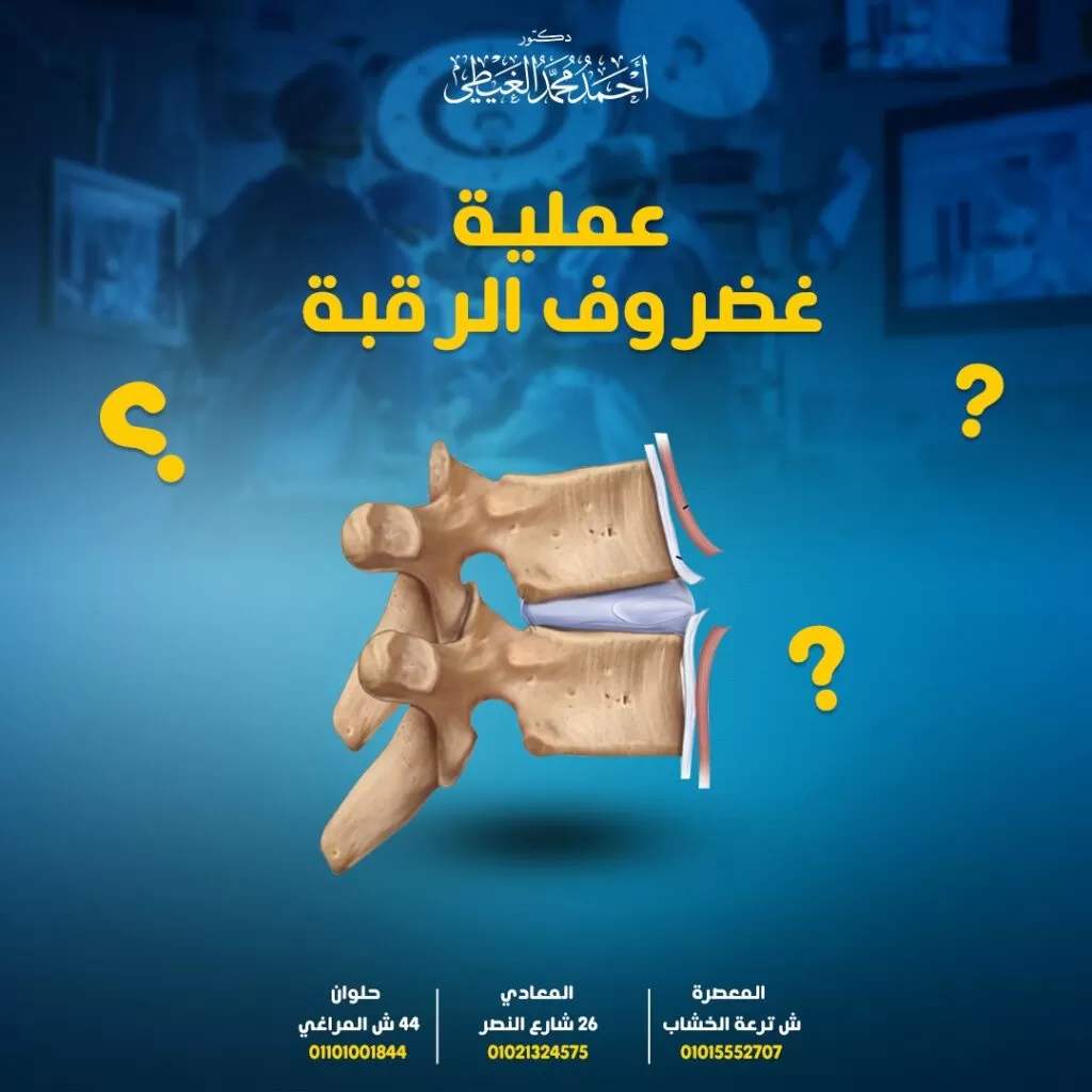 الانزلاق الغضروفي العنقي إلى اختيار عملية غضروف الرقبة في حالة عدم جدوى العلاج وسوء الحالة مع شدة الألم الذي يعانون منه، ويرجع الاختيار الأمثل لطريقة العلاج المناسبة لكل حالة إلى الطبيب المعالج بناءاً على شدة الحالة ومدى سوء الوضع لذلك من خلال المقال سوف نوضح جميع أنواع عمليات غضروف الرقبة والحالات التي تلجأ إليها وكيفية إجرائها. والسؤال هنا هل عملية غضروف الرقبة خطيرة؟ سيجيب دكتور أحمد الغيطي أفضل استشاري جراحة العمود الفقري. محتويات المقالهل عملية غضروف الرقبة خطيرة؟إزالة القرص في عملية غضروف الرقبة الضغط على قناة العمود الفقري العنقياندماج الفقرات العنقيةمميزات استئصال القرص العنقي الأمامي ودمج العمود الفقري ACDFهل عملية غضروف الرقبة خطيرة؟مخاطر و مضاعفات الاستئصال الجراحي الأماميمخاطر الاستئصال الأمامي Corpectomy وهل عملية غضروف الرقبة خطيرة؟تحقيق اندماج العمود الفقري Strut Graftجراحة استبدال القرص الاصطناعي Cervical artificial disc replacementالحفاظ على الحركة في مستوى العمود الفقري بعد الإصلاحفعالية جراحة استبدال القرص الاصطناعيالطريقة الجراحية لعملية الانزلاق الغضروفيإزالة القرصمخاطر استئصال القرص العنقي الخلفيالفرق بين استئصال القرص العنقي الخلفي مقابل الأماميالتعافي من عملية غضروف الرقبةالخلاصةللاستفسارات والحجز بعيادات دكتور أحمد الغيطي: هل عملية غضروف الرقبة خطيرة؟ يعد اختيار عملية غضروف الرقبة بديلاً عن العلاج الغير جراحي إذا استمر الألم لفترة أطول من 6 إلى 12 أسبوعًا مع استمرار الألم الشديد دون استجابة للعلاج. ويتمثل الهدف من الجراحة في إزالة القرص التالف، و فك ضغط جذر العصب والحبل الشوكي مع التخفيف من الألم، ومنع العجز العصبي ، مثل الشعور بالوخز، أو الخدر و التنميل، أو الضعف في الذراع، وتتمثل أنواع جراحات غضروف الرقبة في: استئصال القرص العنقي الأمامي ودمج العمود الفقري (ACDF) Anterior cervical discectomy and spine fusion وتعد الجراحة الأكثر شيوعاً لعلاج الانزلاق الغضروفي العنقي، التي تتم لمستوى واحدة أو لعدة مستويات من العمود الفقري العنقي. حيث تتم إزالة القرص التالف لتخفيف ضغط النخاع الشوكي أو جذر العصب، وبالتالي تقليل الشعور بالألم والخدر والوخز. وتشمل الجراحة الأمامية جزئين، هما: استئصال القرص العنقي الأمامي حيث تتم عملية غضروف الرقبة في الجزء الأمامي من العمود الفقري العنقي، من خلال إزالة القرص من بين عظمتين فقريتين. الدمج ويتم في نفس وقت عملية استئصال القرص لضمان تثبيت الفقرات العنقية من خلال وضع طعم عظمي أو شرائح في مكان القرص الأصلي من أجل توفير المزيد من الاستقرار للمنطقة. كما يتم إجراء تلك الجراحة أيضًا لمرض القرص التنكسي العنقي، و إزالة النتوءات العظمية الناتجة عن التهاب المفاصل، والتخفيف من الأعراض الناتجة عن تضيق العمود الفقري العنقي. خطوات ACDF ل عملية غضروف الرقبة إجراء الفتح الأمامي حيث يتم عمل شق في الجلد بطول 1-2 بوصة على أحد جانبي الرقبة أفقياً داخل تجعد الجلد. أما في الحالات متعددة المستويات يتم عمل شق عمودي بنسبة أكبر. ثم يتم تقسيم العضلة الرقيقة الموجودة تحت الجلد بالتوازي مع شق الجلد ، وإدخال المستوى بين العضلة القصية الترقوية الخشائية وعضلات الشريط. يليها إدخال شريحة بين القصبة الهوائية والمريء وغمد الشريان السباتي. تقوم تلك الطبقة من الأنسجة الليفية بتغطية العمود الفقري ، ثم يتم تشريحها بعيدًا عن مساحة القرص. إزالة القرص في عملية غضروف الرقبة لإزالة القرص في عملية غضروف الرقبة يتم من خلال: يتم أخذ صورة بالأشعة السينية للعمود الفقري أثناء الجراحة للتأكد من مستوى القرص الصحيح للعمود الفقري. يليها إزالة القرص عن طريق قطع الحلقة الليفية حول القرص وإزالة اللب الداخلي اللين للقرص. يتم أيضًا إزالة الألواح الغضروفية الموجودة على عظام العمود الفقري للكشف عن العظم القشري الصلب تحتها. الضغط على قناة العمود الفقري العنقي حيث يتم إجراء تشريح من الأمام إلى الخلف للرباط الطولي الخلفي بين القرص والحبل الشوكي برفق للسماح بالوصول إلى القناة الشوكية وإزالة أي مادة قرصية قد تكون مقذوفة من خلال الرباط ، والتي قد تساهم في تضيق العمود الفقري. هذا بجانب إزالة النتوءات العظمية لتخفيف ضغط النخاع الشوكي أو جذر العصب. ويتم ذلك باستخدام مجهر جراحي أو عدسات مكبرة. اندماج الفقرات العنقية يتم إجراء الاندماج بعد استئصال القرص العنقي، حيث يعمل إدخال الطعم العظمي أو الزرع في مساحة القرص المفرغة على منع انهيار مساحة القرص وتعزيز نمو الفقرتين معًا في وحدة واحدة. الأمر الذي يوفر مساحة كافية لجذور الأعصاب والحبل الشوكي ، ومنع التشوه الموضعي (الحداب). مميزات استئصال القرص العنقي الأمامي ودمج العمود الفقري ACDF تتم هذه عملية غضروف الرقبة في الجزء الأمامي من الرقبة، مما يميزها في: الوصول المباشر إلى القرص حيث تعمل على إزالة هذه الأقراص التي تمثل ضغط مباشر على العصب والحبل الشوكي. كما تمنح الجراحة الأمامية الوصول إلى العمود الفقري العنقي بالكامل تقريبًا ، من الجزء C2 في الجزء العلوي من الرقبة إلى الموصل العنقي الصدري C7-T1 ، حيث انضمام العمود الفقري العنقي إلى العمود الفقري الصدري. تخفيف الألم بعد الجراحة حيث يتم اتباع مسار غير معقد للوصول إلى العمود الفقري مع الشعور بألم جراحي أقل نسبياً من الجراحة الخلفية. كما يساعد تشريح العضلات بقدر محدود على الحد من آلام ما بعد الجراحة. هل عملية غضروف الرقبة خطيرة؟ مخاطر و مضاعفات الاستئصال الجراحي الأمامي ولو أنه من النادر حدوث تلك المضاعفات، إلا أنها قد تحدث في بعض الحالات بالشكل الآتي: نزيف أو تورم دموي في الجرح. سكتة دماغية نتيجة تضرر الشريان السباتي أو الفقري. بحة في الصوت نتيجة تضرر العصب الحنجري السفلي. صعوبة البلع نتيجة تضرر العصب الحنجري العلوي. تضرر المريء أو القصبة الهوائية. تلف الجافية ، مما يؤدي إلى تسرب السائل الدماغي النخاعي. حدوث عدوى الجرح. فشل الاندماج الكافي. تلف الحبل الشوكي أو جذور الأعصاب، مما قد يؤدي إلى الألم، والضعف، والشلل، وفقدان وظيفة الأمعاء أو المثانة، وضعف الوظيفة الجنسية. يتم إجراؤها عندما يشمل الأمر أكثر من مجرد مساحة القرص ، قد يلجأ الجراح إلى إزالة الجسم الفقري، ومسافات القرص لفك الضغط. عادة ما يتم هذا الإجراء لتضيق الفقرات العنقية متعدد المستويات مع ضغط الحبل الشوكي الناجم عن نمو النتوءات العظمية، ويحدث ذلك بالشكل التالي: تتشابه كثيراً مع الاستئصال الأمامي، ولكن على نطاق أوسع عن طريق عمل شق أكبر وأكثر عمودية في الرقبة. يتم إجراء عملية استئصال القرص في أي من طرفي الجسم الفقري الذي سيتم إزالته، مثل C4-C5 و C5-C6 لإزالة الجسم الفقري C5. كما يمكن إزالة أكثر من جسم فقري. يتم إزالة الرباط الطولي الخلفي للسماح بالوصول إلى القناة العنقية، وإزالة الضغط على الحبل الشوكي وجذور الأعصاب. ثم يتم إعادة بناء الخلل باستخدام تقنية الاندماج المناسبة. مخاطر الاستئصال الأمامي Corpectomy وهل عملية غضروف الرقبة خطيرة؟ فنياً، تعد تلك عملية غضروف الرقبة من أصعب جراحات الاستئصال التي يتم إجراؤها في العمود الفقري، متماثلة في ذلك مع استئصال القرص discectomy، وتشمل تشمل المخاطر والمضاعفات المحتملة لتلك الجراحة مايلي: تلف جذر العصب. أو حدوث تلف في الحبل الشوكي. احتمال حدوث نزيف أو عدوى. تضرر القصبة الهوائية، أو المريء. استمرار الشعور بالألم. لذلك، وبالرغم من أن استئصال الجسم هو الإجراء الأكثر شمولاً من استئصال القرص، فإن المخاطر المتعلقة بالمشكلات العصبية وتطعيم العظام والنزيف تكون أكبر، وخاصة تعرض الحبل الشوكي للخطر مما قد يتسبب في شلل رباعي كلي أو جزئي وخاصة أنه ما يتم اتخاذ ذلك الإجراء في ظل وجود مشاكل كبيرة في النخاع الشوكي. لذلك تتم مراقبة وظيفة الحبل الشوكي أثناء الجراحة بواسطة إمكانات الحسية الجسدية (SSEPs)، والتي تقوم بتوليد نبضة كهربائية صغيرة في الذراعين، وتقيس الاستجابة المقابلة في الدماغ مع تسجيل الوقت الذي تستغرقه الإشارة للوصول إلى الدماغ. قد يشير أي تباطؤ ملحوظ في طول الفترة الزمنية إلى مشاكل في الحبل الشوكي. كما أنه قد يتواجد خطر بسيط أثناء إزالة الجسم الفقري ، حيث قد يصاب الشريان الفقري الممتد على جانب العمود الفقري ، مما قد يتسبب في سكتة دماغية أو نزيف. ويكون ذلك الخطر أكثر احتمالاً في حالات إزالة الورم أو التهابات العمود الفقري. تحقيق اندماج العمود الفقري Strut Graft يتم ذلك بعد إجراء عملية استئصال الجسد ، حيث إعادة بناء الخلل، وتوفير استقرار العمود الفقري من خلال اندماج العمود الفقري على المدى الطويل. يتم إدخال قطعة من العظم (1-2 بوصة) في الحوض الذي تم إنشاؤه بواسطة استئصال الجسم الفقري، والذي يدعم العمود الفقري الأمامي يليه استخدام أجهزة أمامية للمساعدة في تثبيت البناء معًا. بدلاً من ذلك ، قد يمكن استخدام دعامات من التيتانيوم أو مواد اصطناعية أخرى بجانب لقم التطعيم العظمي. وفي حالة دمج مستويات متعددة ، فقد يوصى بدمج الملصق التكميلي والأجهزة للمساعدة في استقرار العمود الفقري. جراحة استبدال القرص الاصطناعي Cervical artificial disc replacement تتم إزالة القرص المصاب من خلال شق صغير في مقدمة الرقبة، ثم زرع قرص اصطناعي في مساحة القرص بين الفقرات المجاورة. بحيث يكون الهدف من ذلك القرص الاصطناعي هو محاكاة شكل ووظيفة القرص الأصلي. قبل اختيار إجراء جراحة الاستبدال (ADR) أو ماتعرف برأب مفاصل القرص العنقي، يجب الإلمام بأهداف تلك الجراحة، والتي تشمل: تخفيف ضغط العصب في عملية غضروف الرقبة حيث يهدف التخلص من القرص التالف، واستبداله بآخر اصطناعي إلى تخفيف الضغط على الأعصاب المضغوطة وتوفير مساحة للشفاء والعمل بشكل طبيعي. بالإضافة إلى تخفيف الضغط على الحبل الشوكي ومنع تطور أعراض صعوبة المشي أو التنسيق، أو التحكم في المثانة أو الأمعاء. الحفاظ على الحركة في مستوى العمود الفقري بعد الإصلاح من خلال استبدال القرص التالف بقرص اصطناعي ، والحفاظ الحركة للعمود الفقري العنقي عند تحريك الرقبة. ولكن مع ملاحظة عدم قدرة تلك الجراحة على خلق أن تحسين الحركة، أو حتى زيادة نطاق حركة العمود الفقري العنقي بعد الجراحة. كيفية إجراء جراحة استبدال القرص الاصطناعي يتطلب الإجراء الجراحي القياسي لـ ADR نهجًا أماميًا للعمود الفقري العنقي وهو نفسه المستخدم في جراحة استئصال القرص العنقي الأمامي وجراحة الاندماج (ACDF) في جراحة أحادية المستوى تستغرق ساعة تقريباً. وتتطلب تلك الجراحة بعض الإجراءات قبل أسابيع من إجرائها تتمثل في: الإمتناع عن التدخين، والذي قد يؤدي إلى زيادة احتمالات مضاعفات ما بعد الجراحة، او حدوث عدوى. مراجعة الأدوية المستخدمة مسبقاً، حيث قد تحتاج بعض الأدوية إلى التوقف مؤقتًا أو تقليل الجرعات قبل إجراء الجراحة. إجراء الفحص الجسدي للمريض وتقييمه كلياً للتأكد من تحمله للجراحة، لا يُسمح بتناول الطعام قبل 8 ساعات من الجراحة. وعادة ما تتضمن جراحة ADR أحادية المستوى الخطوات التالية: تطبيق التخدير العام على المريض. إجراء شق من 1 إلى 2 بوصة في الجزء الأمامي من الرقبة. إزالة القرص المصاب وأي نتوءات عظمية) تضغط على جذر العصب أو النخاع الشوكي. استعادة مساحة القرص إلى الارتفاع الطبيعي للمساعدة في تخفيف الضغط على الأعصاب المحيطة. يتم وضع جهاز القرص الاصطناعي في مساحة القرص المعدة باستخدام التصوير المباشر بالأشعة السينية، وقد يقوم الجراح بتجربة أكثر من قرص للوصول إلى الحجم المناسب. ربط القرص الصناعي بالفقرتين المتجاورتين (أعلى وأسفل)، ثم خياطة الشق فعالية جراحة استبدال القرص الاصطناعي بالرغم من كونها من الجراحات الحديثة، إلا أنها آمنة وفعالة في تقليل آلام الرقبة والذراع الناتجة عن ضغط جذر العصب أو الحبل الشوكي. وأوضحت العديد من الدراسات التجريبية أن معدلات النجاح الإكلينيكي لـ ADR تماثل أو قد تكون أفضل من معدلات النجاح الإكلينيكي لـ ACDF، وأن تخفيف الأعراض بعد الجراحة يمكن أن يستمر لسنوات عديدة. استئصال القرص العنقي الخلفي لعملية غضروف الرقبة Posterior cervical discectomy تستخدم تلك الجراحة لعلاج الأقراص العنقية المنفتقة جانبياً في الثقبة العصبية وهي عبارة عن النفق الذي ينتقل من خلالها العصب للخروج من القناة الشوكية. وتعد الجراحة الخلفية أكثر صعوبة من الجراحة الأمامية بسبب وجود العديد من الأوردة في تلك المنطقة والتي من الممكن أن تؤدي إلى نزيف يحد من التصور أثناء الجراحة. كما تتطلب تلك الجراحة مزيدًا من التلاعب بالحبل الشوكي، مما يؤدي إلى زيادة احتمالات حدوث مضاعفات الجراحة. ويتضمن استئصال القرص المجهري الخلفي ما يلي: الطريقة الجراحية لعملية الانزلاق الغضروفي يتم عمل شق صغير في منتصف الجزء الخلفي من الرقبة. ثم يتم رفع العضلات شبه الشوكية عن مستوى العمود الفقري. إزالة القرص أولاً يتم التأكد من إجراء الجراحة في المستوى الصحيح من العمود الفقري عن طريق عمل الأشعة السينية. ثم يتم تحديد جذر العصب تحت المفصل الوجهي، عن طريق استخدام نتوء عالي السرعة لإزالة بعض مفصل الوجه، و استخدام مجهر جراحي لتحسين التصور. يتم تحريك سيكون القرص تحت جذر العصب برفق إلى الجانب لتحرير فتق القرص، مع الوضع في الاعتبار وجود شبكة من الأوردة فوق القرص، والتي من الممكن أن تعيق التصور إذا نزفت. مخاطر استئصال القرص العنقي الخلفي هل عملية غضروف الرقبة خطيرة؟ يتضمن الاستئصال العنقي الخلفي بعض المخاطر المحتملة مثل: تلف جذر العصب. حدوث تلف في الحبل الشوكي. تسرب الجافية Dural leak. احتمالية حدوث عدوى، أو نزيف. استمرار الشكوى من الألم. تكرار الإصابة بالانزلاق الغضروفي. مع ملاحظة، أنه نادراً ما تظهر تلك المضاعفات على المرضى. الفرق بين استئصال القرص العنقي الخلفي مقابل الأمامي تعد الميزة الأساسية للاستئصال الخلفي عن الأمامي في أنه لا يحتاج لإجراء الاندماج، مما يحافظ على الحركة الطبيعية للعمود الفقري العنقي ، ويحتاج وقتاً أقل أقصر للشفاء. أما بالنسبة للعيوب فهي تتمثل في: يكون تصور مساحة القرص محدودًا نتيجة وجود الحبل الشوكي في الطريق، لذلك عادة ما يمكن الاقتراب فقط من فتق القرص الجانبي. احتمالية استمرار الانهيار المرتبط بفتق القرص، والضغط على العصب الموجود في الثقبة العصبية بسبب عدم إدراج الاندماج. وكذلك احتمال حدوث الانفتاق مرة أخرى لعدم إزالة القرص تمامًا. لذلك وبشكل عام، بشكل عام ، يفضل معظم الجراحين إجراء عملية غضروف الرقبة الأمامي بشكل أكبر لأنه الإجراء الأكثر ثقة وانهاء الوضع. التعافي من عملية غضروف الرقبة بعد الجراحة، يكون المريض قادرًا على النهوض والحركة في خلال ساعات قليلة والعودة إلى المنزل في نفس اليوم أو في صباح اليوم التالي، مع الشعور ببعض الألم في المنطقة التي أجريت فيها الجراحة والذي يقل تدريجياً. يستغرق الاندماج من ثلاثة أشهر إلى عام بعد الجراحة مع استمرار بعض الأعراض لفترة. قد يوصي الطبيب بارتداء طوق العنق لفترة لتوفير الدعم للرقبة من 4-6 أسابيع. هذا بجانب بعض الممارسات الصحية لتسريع التعافي مثل اتباع نظام غذائي صحي ، وعدم التدخين ، وممارسة التمارين الرياضية المناسبة للجراحة. الخلاصة على الرغم من وجود مخاطر ومضاعفات محتملة لأي عملية جراحية ، إلا أن عملية غضروف الرقبة تعد من الجراحات نادرة المضاعفات وخاصة عمليات ACDF والاستبدال الاصطناعي للقرص الأكثر شيوعاً ، والتي تعد من العمليات الجراحية الموثوقة ذات النتائج الإيجابية من حيث تقليل الألم والوخز الناجم عن انضغاط الجذر العصبي من هو أفضل دكتور مخ واعصاب لإجراء عملية غضروف الرقبة أفضل وأحسن دكتور جراحات العمود الفقري والتدخل المحدود يقوم بعملية غضروف الرقبة بالجراحة هو جراح العمود الفقري والتدخل المحدود الذي تدرب على فروع جراحات العمود الفقري والتدخل المحدود متناهية الدقة والميكروسكوبية, سواء باستخدام الميكروسكوب الجراحي أو باستخدام المنظار . كما يجب أن يكون متمكنا من دراسة التاريخ المرضي للحالة بدقة والتأكد من نوع التعب الموجود لدى المريض. ويقوم دكتور أحمد الغيطي باجراء كافة جراحات العمود الفقري والتدخل المحدود سواء ميكروسكوبيا أو بالمنظار وهل عملية غضروف الرقبة خطيرة سوف يجيب دكتور أحمد الغيطي. عيادة دكتور أحمد الغيطي استشاري جراحة المخ والأعصاب والعمود الفقري اقرأ أيضا: (مصادر) علاج الغضروف القطني الانزلاق الغضروفي العنقي فى عيادات دكتور أحمد الغيطي نحرص على اتباع الخطوات اللازمة للتعرف على حالتك وبناء خطة علاجية فعالة. اضغط هنا لحجز موعد في عيادة دكتور أحمد الغيطي لعملية غضروف الرقبة دكتور أحمد الغيطي استشاري جراحة المخ والأعصاب والعمود الفقري. استشاري القسطرة المخية التداخلية وجراحات المخ والأعصاب الوظيفية وجراحة الصرع. دكتوراه جراحة المخ والأعصاب – كلية طب القصر العيني – جامعة القاهرة. زميل البورد الأوربي للجراحات العصبية (FEBNS). تابعونا على صفحة الفيسبوك من هنا عملية غضروف الرقبة يلجأ الكثير من حالات الانزلاق الغضروفي العنقي إلى اختيار عملية غضروف الرقبة في حالة عدم جدوى العلاج وسوء الحالة مع شدة الألم الذي يعانون منه، ويرجع الاختيار الأمثل لطريقة العلاج المناسبة لكل حالة إلى الطبيب المعالج بناءاً على شدة الحالة ومدى سوء الوضع لذلك من خلال المقال سوف نوضح جميع أنواع عمليات غضروف الرقبة والحالات التي تلجأ إليها وكيفية إجرائها. والسؤال هنا هل عملية غضروف الرقبة خطيرة؟ سيجيب دكتور أحمد الغيطي أفضل استشاري جراحة العمود الفقري. احجز الآن مع دكتور أحمد الغيطي من هنا محتويات المقال هل عملية غضروف الرقبة خطيرة؟ إزالة القرص في عملية غضروف الرقبة الضغط على قناة العمود الفقري العنقي اندماج الفقرات العنقية مميزات استئصال القرص العنقي الأمامي ودمج العمود الفقري ACDF هل عملية غضروف الرقبة خطيرة؟ مخاطر و مضاعفات الاستئصال الجراحي الأمامي مخاطر الاستئصال الأمامي Corpectomy وهل عملية غضروف الرقبة خطيرة؟ تحقيق اندماج العمود الفقري Strut Graft جراحة استبدال القرص الاصطناعي Cervical artificial disc replacement الحفاظ على الحركة في مستوى العمود الفقري بعد الإصلاح فعالية جراحة استبدال القرص الاصطناعي الطريقة الجراحية لعملية الانزلاق الغضروفي إزالة القرص مخاطر استئصال القرص العنقي الخلفي الفرق بين استئصال القرص العنقي الخلفي مقابل الأمامي التعافي من عملية غضروف الرقبة الخلاصة للاستفسارات والحجز بعيادات دكتور أحمد الغيطي: هل عملية غضروف الرقبة خطيرة؟ يعد اختيار عملية غضروف الرقبة بديلاً عن العلاج الغير جراحي إذا استمر الألم لفترة أطول من 6 إلى 12 أسبوعًا مع استمرار الألم الشديد دون استجابة للعلاج. ويتمثل الهدف من الجراحة في إزالة القرص التالف، و فك ضغط جذر العصب والحبل الشوكي مع التخفيف من الألم، ومنع العجز العصبي ، مثل الشعور بالوخز، أو الخدر و التنميل، أو الضعف في الذراع، وتتمثل أنواع جراحات غضروف الرقبة في: استئصال القرص العنقي الأمامي ودمج العمود الفقري (ACDF) Anterior cervical discectomy and spine fusion وتعد الجراحة الأكثر شيوعاً لعلاج الانزلاق الغضروفي العنقي، التي تتم لمستوى واحدة أو لعدة مستويات من العمود الفقري العنقي. حيث تتم إزالة القرص التالف لتخفيف ضغط النخاع الشوكي أو جذر العصب، وبالتالي تقليل الشعور بالألم والخدر والوخز. وتشمل الجراحة الأمامية جزئين، هما: استئصال القرص العنقي الأمامي حيث تتم عملية غضروف الرقبة في الجزء الأمامي من العمود الفقري العنقي، من خلال إزالة القرص من بين عظمتين فقريتين. الدمج ويتم في نفس وقت عملية استئصال القرص لضمان تثبيت الفقرات العنقية من خلال وضع طعم عظمي أو شرائح في مكان القرص الأصلي من أجل توفير المزيد من الاستقرار للمنطقة. كما يتم إجراء تلك الجراحة أيضًا لمرض القرص التنكسي العنقي، و إزالة النتوءات العظمية الناتجة عن التهاب المفاصل، والتخفيف من الأعراض الناتجة عن تضيق العمود الفقري العنقي. خطوات ACDF ل عملية غضروف الرقبة إجراء الفتح الأمامي حيث يتم عمل شق في الجلد بطول 1-2 بوصة على أحد جانبي الرقبة أفقياً داخل تجعد الجلد. أما في الحالات متعددة المستويات يتم عمل شق عمودي بنسبة أكبر. ثم يتم تقسيم العضلة الرقيقة الموجودة تحت الجلد بالتوازي مع شق الجلد ، وإدخال المستوى بين العضلة القصية الترقوية الخشائية وعضلات الشريط. يليها إدخال شريحة بين القصبة الهوائية والمريء وغمد الشريان السباتي. تقوم تلك الطبقة من الأنسجة الليفية بتغطية العمود الفقري ، ثم يتم تشريحها بعيدًا عن مساحة القرص. إزالة القرص في عملية غضروف الرقبة لإزالة القرص في عملية غضروف الرقبة يتم من خلال: يتم أخذ صورة بالأشعة السينية للعمود الفقري أثناء الجراحة للتأكد من مستوى القرص الصحيح للعمود الفقري. يليها إزالة القرص عن طريق قطع الحلقة الليفية حول القرص وإزالة اللب الداخلي اللين للقرص. يتم أيضًا إزالة الألواح الغضروفية الموجودة على عظام العمود الفقري للكشف عن العظم القشري الصلب تحتها. الضغط على قناة العمود الفقري العنقي حيث يتم إجراء تشريح من الأمام إلى الخلف للرباط الطولي الخلفي بين القرص والحبل الشوكي برفق للسماح بالوصول إلى القناة الشوكية وإزالة أي مادة قرصية قد تكون مقذوفة من خلال الرباط ، والتي قد تساهم في تضيق العمود الفقري. هذا بجانب إزالة النتوءات العظمية لتخفيف ضغط النخاع الشوكي أو جذر العصب. ويتم ذلك باستخدام مجهر جراحي أو عدسات مكبرة. اندماج الفقرات العنقية يتم إجراء الاندماج بعد استئصال القرص العنقي، حيث يعمل إدخال الطعم العظمي أو الزرع في مساحة القرص المفرغة على منع انهيار مساحة القرص وتعزيز نمو الفقرتين معًا في وحدة واحدة. الأمر الذي يوفر مساحة كافية لجذور الأعصاب والحبل الشوكي ، ومنع التشوه الموضعي (الحداب). مميزات استئصال القرص العنقي الأمامي ودمج العمود الفقري ACDF تتم هذه عملية غضروف الرقبة في الجزء الأمامي من الرقبة، مما يميزها في: الوصول المباشر إلى القرص حيث تعمل على إزالة هذه الأقراص التي تمثل ضغط مباشر على العصب والحبل الشوكي. كما تمنح الجراحة الأمامية الوصول إلى العمود الفقري العنقي بالكامل تقريبًا ، من الجزء C2 في الجزء العلوي من الرقبة إلى الموصل العنقي الصدري C7-T1 ، حيث انضمام العمود الفقري العنقي إلى العمود الفقري الصدري. تخفيف الألم بعد الجراحة حيث يتم اتباع مسار غير معقد للوصول إلى العمود الفقري مع الشعور بألم جراحي أقل نسبياً من الجراحة الخلفية. كما يساعد تشريح العضلات بقدر محدود على الحد من آلام ما بعد الجراحة. هل عملية غضروف الرقبة خطيرة؟ مخاطر و مضاعفات الاستئصال الجراحي الأمامي ولو أنه من النادر حدوث تلك المضاعفات، إلا أنها قد تحدث في بعض الحالات بالشكل الآتي: نزيف أو تورم دموي في الجرح. سكتة دماغية نتيجة تضرر الشريان السباتي أو الفقري. بحة في الصوت نتيجة تضرر العصب الحنجري السفلي. صعوبة البلع نتيجة تضرر العصب الحنجري العلوي. تضرر المريء أو القصبة الهوائية. تلف الجافية ، مما يؤدي إلى تسرب السائل الدماغي النخاعي. حدوث عدوى الجرح. فشل الاندماج الكافي. تلف الحبل الشوكي أو جذور الأعصاب، مما قد يؤدي إلى الألم، والضعف، والشلل، وفقدان وظيفة الأمعاء أو المثانة، وضعف الوظيفة الجنسية. يتم إجراؤها عندما يشمل الأمر أكثر من مجرد مساحة القرص ، قد يلجأ الجراح إلى إزالة الجسم الفقري، ومسافات القرص لفك الضغط. عادة ما يتم هذا الإجراء لتضيق الفقرات العنقية متعدد المستويات مع ضغط الحبل الشوكي الناجم عن نمو النتوءات العظمية، ويحدث ذلك بالشكل التالي: تتشابه كثيراً مع الاستئصال الأمامي، ولكن على نطاق أوسع عن طريق عمل شق أكبر وأكثر عمودية في الرقبة. يتم إجراء عملية استئصال القرص في أي من طرفي الجسم الفقري الذي سيتم إزالته، مثل C4-C5 و C5-C6 لإزالة الجسم الفقري C5. كما يمكن إزالة أكثر من جسم فقري. يتم إزالة الرباط الطولي الخلفي للسماح بالوصول إلى القناة العنقية، وإزالة الضغط على الحبل الشوكي وجذور الأعصاب. ثم يتم إعادة بناء الخلل باستخدام تقنية الاندماج المناسبة. مخاطر الاستئصال الأمامي Corpectomy وهل عملية غضروف الرقبة خطيرة؟ فنياً، تعد تلك عملية غضروف الرقبة من أصعب جراحات الاستئصال التي يتم إجراؤها في العمود الفقري، متماثلة في ذلك مع استئصال القرص discectomy، وتشمل تشمل المخاطر والمضاعفات المحتملة لتلك الجراحة مايلي: تلف جذر العصب. أو حدوث تلف في الحبل الشوكي. احتمال حدوث نزيف أو عدوى. تضرر القصبة الهوائية، أو المريء. استمرار الشعور بالألم. لذلك، وبالرغم من أن استئصال الجسم هو الإجراء الأكثر شمولاً من استئصال القرص، فإن المخاطر المتعلقة بالمشكلات العصبية وتطعيم العظام والنزيف تكون أكبر، وخاصة تعرض الحبل الشوكي للخطر مما قد يتسبب في شلل رباعي كلي أو جزئي وخاصة أنه ما يتم اتخاذ ذلك الإجراء في ظل وجود مشاكل كبيرة في النخاع الشوكي. لذلك تتم مراقبة وظيفة الحبل الشوكي أثناء الجراحة بواسطة إمكانات الحسية الجسدية (SSEPs)، والتي تقوم بتوليد نبضة كهربائية صغيرة في الذراعين، وتقيس الاستجابة المقابلة في الدماغ مع تسجيل الوقت الذي تستغرقه الإشارة للوصول إلى الدماغ. قد يشير أي تباطؤ ملحوظ في طول الفترة الزمنية إلى مشاكل في الحبل الشوكي. كما أنه قد يتواجد خطر بسيط أثناء إزالة الجسم الفقري ، حيث قد يصاب الشريان الفقري الممتد على جانب العمود الفقري ، مما قد يتسبب في سكتة دماغية أو نزيف. ويكون ذلك الخطر أكثر احتمالاً في حالات إزالة الورم أو التهابات العمود الفقري. تحقيق اندماج العمود الفقري Strut Graft يتم ذلك بعد إجراء عملية استئصال الجسد ، حيث إعادة بناء الخلل، وتوفير استقرار العمود الفقري من خلال اندماج العمود الفقري على المدى الطويل. يتم إدخال قطعة من العظم (1-2 بوصة) في الحوض الذي تم إنشاؤه بواسطة استئصال الجسم الفقري، والذي يدعم العمود الفقري الأمامي يليه استخدام أجهزة أمامية للمساعدة في تثبيت البناء معًا. بدلاً من ذلك ، قد يمكن استخدام دعامات من التيتانيوم أو مواد اصطناعية أخرى بجانب لقم التطعيم العظمي. وفي حالة دمج مستويات متعددة ، فقد يوصى بدمج الملصق التكميلي والأجهزة للمساعدة في استقرار العمود الفقري. جراحة استبدال القرص الاصطناعي Cervical artificial disc replacement احجز الآن مع دكتور أحمد الغيطي من هنا تتم إزالة القرص المصاب من خلال شق صغير في مقدمة الرقبة، ثم زرع قرص اصطناعي في مساحة القرص بين الفقرات المجاورة. بحيث يكون الهدف من ذلك القرص الاصطناعي هو محاكاة شكل ووظيفة القرص الأصلي. قبل اختيار إجراء جراحة الاستبدال (ADR) أو ماتعرف برأب مفاصل القرص العنقي، يجب الإلمام بأهداف تلك الجراحة، والتي تشمل: تخفيف ضغط العصب في عملية غضروف الرقبة حيث يهدف التخلص من القرص التالف، واستبداله بآخر اصطناعي إلى تخفيف الضغط على الأعصاب المضغوطة وتوفير مساحة للشفاء والعمل بشكل طبيعي. بالإضافة إلى تخفيف الضغط على الحبل الشوكي ومنع تطور أعراض صعوبة المشي أو التنسيق، أو التحكم في المثانة أو الأمعاء. الحفاظ على الحركة في مستوى العمود الفقري بعد الإصلاح من خلال استبدال القرص التالف بقرص اصطناعي ، والحفاظ الحركة للعمود الفقري العنقي عند تحريك الرقبة. ولكن مع ملاحظة عدم قدرة تلك الجراحة على خلق أن تحسين الحركة، أو حتى زيادة نطاق حركة العمود الفقري العنقي بعد الجراحة. كيفية إجراء جراحة استبدال القرص الاصطناعي يتطلب الإجراء الجراحي القياسي لـ ADR نهجًا أماميًا للعمود الفقري العنقي وهو نفسه المستخدم في جراحة استئصال القرص العنقي الأمامي وجراحة الاندماج (ACDF) في جراحة أحادية المستوى تستغرق ساعة تقريباً. وتتطلب تلك الجراحة بعض الإجراءات قبل أسابيع من إجرائها تتمثل في: الإمتناع عن التدخين، والذي قد يؤدي إلى زيادة احتمالات مضاعفات ما بعد الجراحة، او حدوث عدوى. مراجعة الأدوية المستخدمة مسبقاً، حيث قد تحتاج بعض الأدوية إلى التوقف مؤقتًا أو تقليل الجرعات قبل إجراء الجراحة. إجراء الفحص الجسدي للمريض وتقييمه كلياً للتأكد من تحمله للجراحة، لا يُسمح بتناول الطعام قبل 8 ساعات من الجراحة. وعادة ما تتضمن جراحة ADR أحادية المستوى الخطوات التالية: تطبيق التخدير العام على المريض. إجراء شق من 1 إلى 2 بوصة في الجزء الأمامي من الرقبة. إزالة القرص المصاب وأي نتوءات عظمية) تضغط على جذر العصب أو النخاع الشوكي. استعادة مساحة القرص إلى الارتفاع الطبيعي للمساعدة في تخفيف الضغط على الأعصاب المحيطة. يتم وضع جهاز القرص الاصطناعي في مساحة القرص المعدة باستخدام التصوير المباشر بالأشعة السينية، وقد يقوم الجراح بتجربة أكثر من قرص للوصول إلى الحجم المناسب. ربط القرص الصناعي بالفقرتين المتجاورتين (أعلى وأسفل)، ثم خياطة الشق فعالية جراحة استبدال القرص الاصطناعي بالرغم من كونها من الجراحات الحديثة، إلا أنها آمنة وفعالة في تقليل آلام الرقبة والذراع الناتجة عن ضغط جذر العصب أو الحبل الشوكي. وأوضحت العديد من الدراسات التجريبية أن معدلات النجاح الإكلينيكي لـ ADR تماثل أو قد تكون أفضل من معدلات النجاح الإكلينيكي لـ ACDF، وأن تخفيف الأعراض بعد الجراحة يمكن أن يستمر لسنوات عديدة. استئصال القرص العنقي الخلفي لعملية غضروف الرقبة Posterior cervical discectomy تستخدم تلك الجراحة لعلاج الأقراص العنقية المنفتقة جانبياً في الثقبة العصبية وهي عبارة عن النفق الذي ينتقل من خلالها العصب للخروج من القناة الشوكية. وتعد الجراحة الخلفية أكثر صعوبة من الجراحة الأمامية بسبب وجود العديد من الأوردة في تلك المنطقة والتي من الممكن أن تؤدي إلى نزيف يحد من التصور أثناء الجراحة. كما تتطلب تلك الجراحة مزيدًا من التلاعب بالحبل الشوكي، مما يؤدي إلى زيادة احتمالات حدوث مضاعفات الجراحة. ويتضمن استئصال القرص المجهري الخلفي ما يلي: الطريقة الجراحية لعملية الانزلاق الغضروفي يتم عمل شق صغير في منتصف الجزء الخلفي من الرقبة. ثم يتم رفع العضلات شبه الشوكية عن مستوى العمود الفقري. إزالة القرص أولاً يتم التأكد من إجراء الجراحة في المستوى الصحيح من العمود الفقري عن طريق عمل الأشعة السينية. ثم يتم تحديد جذر العصب تحت المفصل الوجهي، عن طريق استخدام نتوء عالي السرعة لإزالة بعض مفصل الوجه، و استخدام مجهر جراحي لتحسين التصور. يتم تحريك سيكون القرص تحت جذر العصب برفق إلى الجانب لتحرير فتق القرص، مع الوضع في الاعتبار وجود شبكة من الأوردة فوق القرص، والتي من الممكن أن تعيق التصور إذا نزفت. مخاطر استئصال القرص العنقي الخلفي هل عملية غضروف الرقبة خطيرة؟ يتضمن الاستئصال العنقي الخلفي بعض المخاطر المحتملة مثل: تلف جذر العصب. حدوث تلف في الحبل الشوكي. تسرب الجافية Dural leak. احتمالية حدوث عدوى، أو نزيف. استمرار الشكوى من الألم. تكرار الإصابة بالانزلاق الغضروفي. مع ملاحظة، أنه نادراً ما تظهر تلك المضاعفات على المرضى. الفرق بين استئصال القرص العنقي الخلفي مقابل الأمامي تعد الميزة الأساسية للاستئصال الخلفي عن الأمامي في أنه لا يحتاج لإجراء الاندماج، مما يحافظ على الحركة الطبيعية للعمود الفقري العنقي ، ويحتاج وقتاً أقل أقصر للشفاء. أما بالنسبة للعيوب فهي تتمثل في: يكون تصور مساحة القرص محدودًا نتيجة وجود الحبل الشوكي في الطريق، لذلك عادة ما يمكن الاقتراب فقط من فتق القرص الجانبي. احتمالية استمرار الانهيار المرتبط بفتق القرص، والضغط على العصب الموجود في الثقبة العصبية بسبب عدم إدراج الاندماج. وكذلك احتمال حدوث الانفتاق مرة أخرى لعدم إزالة القرص تمامًا. لذلك وبشكل عام، بشكل عام ، يفضل معظم الجراحين إجراء عملية غضروف الرقبة الأمامي بشكل أكبر لأنه الإجراء الأكثر ثقة وانهاء الوضع. التعافي من عملية غضروف الرقبة بعد الجراحة، يكون المريض قادرًا على النهوض والحركة في خلال ساعات قليلة والعودة إلى المنزل في نفس اليوم أو في صباح اليوم التالي، مع الشعور ببعض الألم في المنطقة التي أجريت فيها الجراحة والذي يقل تدريجياً. يستغرق الاندماج من ثلاثة أشهر إلى عام بعد الجراحة مع استمرار بعض الأعراض لفترة. قد يوصي الطبيب بارتداء طوق العنق لفترة لتوفير الدعم للرقبة من 4-6 أسابيع. هذا بجانب بعض الممارسات الصحية لتسريع التعافي مثل اتباع نظام غذائي صحي ، وعدم التدخين ، وممارسة التمارين الرياضية المناسبة للجراحة. الخلاصة على الرغم من وجود مخاطر ومضاعفات محتملة لأي عملية جراحية ، إلا أن عملية غضروف الرقبة تعد من الجراحات نادرة المضاعفات وخاصة عمليات ACDF والاستبدال الاصطناعي للقرص الأكثر شيوعاً ، والتي تعد من العمليات الجراحية الموثوقة ذات النتائج الإيجابية من حيث تقليل الألم والوخز الناجم عن انضغاط الجذر العصبي من هو أفضل دكتور مخ واعصاب لإجراء عملية غضروف الرقبة أفضل وأحسن دكتور جراحات العمود الفقري والتدخل المحدود يقوم بعملية غضروف الرقبة بالجراحة هو جراح العمود الفقري والتدخل المحدود الذي تدرب على فروع جراحات العمود الفقري والتدخل المحدود متناهية الدقة والميكروسكوبية, سواء باستخدام الميكروسكوب الجراحي أو باستخدام المنظار . كما يجب أن يكون متمكنا من دراسة التاريخ المرضي للحالة بدقة والتأكد من نوع التعب الموجود لدى المريض. ويقوم دكتور أحمد الغيطي باجراء كافة جراحات العمود الفقري والتدخل المحدود سواء ميكروسكوبيا أو بالمنظار وهل عملية غضروف الرقبة خطيرة سوف يجيب دكتور أحمد الغيطي. أراء مرضى دكتور أحمد الغيطي أفضل دكتور جراحة مخ وأعصاب العمليات التي يجريها دكتور أحمد الغيطي مجموعة من صور أشعات بعض المرضى قبل وبعد اجراء تدخلات جراحية لعلاج حالتهم, قام باجراء الجراحات دكتور أحمد الغيطي. يقوم دكتور أحمد الغيطي بإجراء جراحات أورام المخ والنخاع الشوكي, أورام قاع الجمجمة, غلق التمددات الشريانية والتشوهات الشريانية الوريدية جراحيا وعن طريق القسطرة المخية التداخلية. يقوم دكتور أحمد الغيطي باجراء جراحات العمود الفقري متناهية الدقة كاستئصال الانزلاق الغضروفي العنقي والقطني بالميكروسكوب أو المنظار الجراحي. عيادة دكتور أحمد الغيطي استشاري جراحة المخ والأعصاب والعمود الفقري اقرأ أيضا: (مصادر) علاج الغضروف القطني الانزلاق الغضروفي العنقي فى عيادات دكتور أحمد الغيطي نحرص على اتباع الخطوات اللازمة للتعرف على حالتك وبناء خطة علاجية فعالة. اضغط هنا لحجز موعد في عيادة دكتور أحمد الغيطي لعملية غضروف الرقبة دكتور أحمد الغيطي استشاري جراحة المخ والأعصاب والعمود الفقري. استشاري القسطرة المخية التداخلية وجراحات المخ والأعصاب الوظيفية وجراحة الصرع. دكتوراه جراحة المخ والأعصاب – كلية طب القصر العيني – جامعة القاهرة. زميل البورد الأوربي للجراحات العصبية (FEBNS). تابعونا على صفحة الفيسبوك من هنا صفحة الفيسبوك للاستفسارات والحجز بعيادات دكتور أحمد الغيطي: عيادة المعادي: 26 شارع النصر أعلى فودافون ت/ 01021324575 وعيادة حلوان: 44 شارع المراغي بجوار محطة مترو حلوان ت: 01101001844 عيادة المعصرة: ش ترعة الخشاب فوق كافيتيريا اللؤلؤة ت/ 01015552707 احجز الآن مع دكتور أحمد الغيطي من هنا