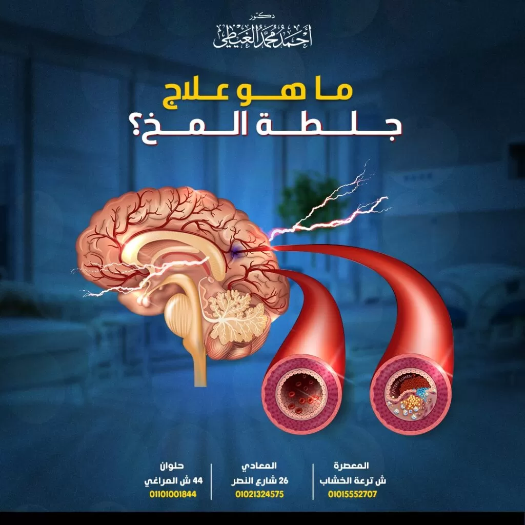 علاج جلطة المخ يمنع علاج جلطة المخ تعرض المريض إلى إعاقة طويلة الأمد ويساهم في إنقاذ حياته . العلاج الدوائي كيف تعمل أدوية علاج جلطة المخ؟ عادةً ما تعمل الأدوية المستخدمة في علاج جلطة المخ بطرق مختلفة. تعمل بعض أدوية جلطة المخ على تفتيت الجلطات الدموية و يساعد البعض الآخر في منع تكون الجلطات بداخل الأوعية الدموية و هناك أنواع أخرى من الأدوية المستخدمة في ضبط ارتفاع ضغط الدم ومستويات الكوليسترول للمساعدة في منع انسداد الأوعية الدموية. يعتمد الدواء المستخدم في علاج جلطة المخ الذي على نوع السكتة الدماغية وسببها. ويمكن أيضًا استخدام أدوية السكتة الدماغية للمساعدة في منع تكرار حدوثها لدى الأشخاص الذين أصيبوا بها بالفعل. العلاج الطارئ لجلطة المخ تعتبر الإصابة بجلطة المخ حالة طارئة تحتاج التدخل العاجل دون أي تأخير.و إذا تلقى المريض علاجًا سريعًا ، فستكون فرص شفائه أعلى. بدايةً سيحاول الطبيب إذابة الجلطة وغالباً ما يتم إعطاء الأسبرين لضمان عدم وجود تجلطات أخرى. وبعد ذلك يتم توفير أدوية إذابة الجلطات مثل مضادات التخثر ومنشط البلازمينوجين النسيجي وغيرها من الأدوية التي يصفها الطبيب المعالج. أدوية إذابة جلطة المخ من الضروري سرعة التدخل الطبي خلال الساعات الثلاث الأولي من بداية ظهور أعراض جلطة المخ ويتم إعطاء المريض أدوية لإذابة الجلطة المتكونة. أحد أهم أدوية إذابة وتكسير الجلطات المتكونة بداخل الأوعية الدموية هو عقار “منشط البلازمينوجين النسيجي” (Tissue plasminogen activator – TPA) أو ما يعرف باسم “ألتيبلاز” ويتم استخدامه كعلاج طارئ شائع أثناء السكتة الدماغية. دواء ألتيبلاز غالبًا ما يمكن علاج جلطة المخ (السكتات الدماغية الإقفارية) باستخدام حقن دواء “ألتيبلاز” الذي يذيب الجلطات الدموية ويعيد تدفق الدم إلى أنسجة المخ. يكون دواء ألتيبلاز(Alteplase) أكثر فاعلية إذا بدأ في أقرب وقت ممكن بعد حدوث الجلطة الدماغية في خلال 4 ساعات على الأكثر.لأنه ليس من الواضح مدى فائدته عند استخدامه بعد مرورهذا الوقت. يتم حقن دواء ألتيبلاز في الوريد حتى يتمكن من الوصول إلى الجلطة الدموية بسرعة، وجب التنويه على أن هذا الدواء لا يُعطى للأشخاص المعرضون لخطر النزيف في المخ.لذلك من المهم جدًا إجراء فحص للمخ لتأكيد تشخيص جلطة المخ قبل استخدام alteplase. تبدأ جلطة المخ بالذوبان والتحلل خلال 30 دقيقة بعد حقن الدواء وتذوب تماماً الجلطة بعد مرور ساعة على أقصى تقدير. مضادات التخثر (الأدوية المسيلة للدم) مضادات التخثر هي أدوية تساعد على منع الدم من التجلط بسهولة من خلال استهداف بروتينات معينة تسبب تخثر الدم. تمنع مضادات التخثر تكون الجلطات من خلال تغيير التركيب الكيميائي للدم. تساهم أيضاً في الوقاية من جلطة المخ والسكتة الدماغية الصغيرة. أمثلة لمضادات التخثر: الهيبارين: يتميز بمفعوله السريع ويتم استخدامه على المدى القصير في المستشفى. مضادات التخثر للاستخدام طويل الأمد: الوارفارين (كومادين ، جانتوفين) لمنع تكون جلطات الدم وأيضاً يمنع زيادة حجم الجلطات الموجودة. أمثلة لبعض مضادات التخثر التي تمتلك مفعولاً أقصر من الوارفارين والتي لاتحتاج إلى إجراء اختبارات منتظمة للدم : أبيكسابان (إليكويس) دابيجاتران (Dabigatran) ريفاروكسابان. إدوكسابان. من هم الأشخاص المرشحون لاستخدام مضادات التخثر؟ غالبًا ما يوصف الوارفارين للأشخاص الذين لديهم صمامات القلب الصناعية. الإصابة السابقة بجلطة في أوردة الساق (DVT). مرضى القلب الذين لديهم ضربات قلب غير منتظمة أويعانون من الرجفان الأذيني (AF). الأشخاص الذين تعرضوا للإصابة بنوبة قلبية أو جلطة دماغية سابقة. الأدوية المضادة للصفائح الدموية تُستخدم مضادات الصفائح الدموية مثل كلوبيدوجريل (بلافيكس) وهو دواء مانع لتجلط الدم من خلال منع الصفائح الدموية من التكتل وتكوين الجلطات. كيف تعمل الأدوية المضادة للصفائح الدموية؟ تعمل هذه الأدوية عن طريق منع التصاق الصفائح الدموية ببعضها البعض بهدف منع تكون الجلطات. توصف هذه الأدوية للأشخاص الذين أصيبوا بالسكتات الدماغية أو النوبات القلبية، لذلك يوصي الأطباء بتناولها بشكل منتظم لفترات طويلة كوسيلة لمنع حدوث جلطة المخ أو النوبة القلبية. الأسبرين هو أحد أنواع الأدوية المضادة للصفائح الدموية ولكنه يرتبط بارتفاع مخاطر التعرض للنزيف.لذلك فإن العلاج بالأسبرين ليس دائمًا الاختيار الأفضل للأشخاص الذين ليس لديهم تاريخ سابق للإصابة بأمراض القلب والأوعية الدموية و تصلب الشرايين (مثل السكتة الدماغية والنوبات القلبية). العقاقير المخفضة للكوليسترول (الستاتينات) تساهم هذه الأدوية في خفض مستويات الكوليسترول المرتفعة حيث يبدأ الكوليسترول في التراكم على طول جدران الشرايين مسبباً تصلب الشرايين. تثبط هذه الأدوية إنزيم معين في الكبد يحتاجه الجسم لإنتاج الكوليسترول. ونتيجة لذلك يقل إنتاجه في الجسم مما يساعد ذلك في تقليل مخاطر تصلب الشرايين والوقاية من السكتات الدماغية والنوبات القلبية الناجمة عن انسداد الشرايين. تشمل العقاقير المخفضة للكوليسترول ما يلي: أتورفاستاتين (ليبيتور) بيتافاستاتين (ليفالو) رسيوفاستاتين (كريستور) أدوية ضغط الدم يلعب ارتفاع ضغط الدم دورًا رئيسيًا في الإصابة بجلطة المخ. وتشمل أدوية علاج ضغط الدم المرتفع ما يلي: مثبطات الإنزيم المحول للأنجيوتنسين. حاصرات بيتا حاصرات قنوات الكالسيوم. استخدام القسطرة لإزالة الجلطة من الشريان المصاب يمكن إجراء هذاالتدخل الطبي بعد يوم من ظهور أعراض جلطة المخ. يتضمن الإجراء إدخال قسطرة في الشريان الفخذي للوصول الى الشريان السباتي. ثم يتم تمرير جهاز صغير عبر القسطرة إلى الشريان المصاب في المخ. يمكن بعد ذلك إزالة الجلطة الدموية باستخدام الجهاز، أو من خلال الشفط. ثم يتم ادخال بالون لفتح الانسداد ووضع دعامة داخل الشريان لمنع الانسداد وزيادة تدفق الدم داخل الشريان. استئصال باطنة الشريان السباتي هو عبارة عن تدخل جراحي لفتح الشريان السباتي في حالة وجود تضيق شديد للشريان. قد تحدث جلطة المخ بسبب ضيق أحد شرايين الرقبة التي توصل الإمداد الدموي للمخ “الشريان السباتي” بسبب تراكم الترسبات الدهنية على جدران الشريان. يتضمن هذا الإجراء عمل شق جراحي في الرقبة لفتح الشريان السباتي وإزالة الرواسب الدهنية. يمتلك هذا الإجراء بعض الخطورة بالنسبة للأشخاص الذين يعانون من حالات طبية معينة أو الذين يعانون من مشاكل في القلب . الوقاية من السكتة الدماغية علاج ارتفاع ضغط الدم والالتزام بالأدوية التي يصفها الطبيب والحد من تناول الأطعمة المالحة. الإقلاع عن التدخين لأنه يزيد من خطر الإصابة بسكتة دماغية ويجب أيضاً تجنب التدخين السلبي. اتباع نمط غذائي صحي لذلك يوصى بالفواكه والخضروات الطازجة التي تحتوي على نسبة عالية من الألياف لأنها تساعد في منع السكتة الدماغية، أثبتت الدراسات أن تناول الكثير من الفواكه والخضروات يمكن أن يقلل من فرص الإصابة بالسكتة الدماغية بنسبة 21٪. تقليل تناول الأطعمة الغنية بالدهون غير المشبعة والدهون المشبعة للتحكم في مستوى الكوليسترول في الجسم. ممارسة التمارين الرياضية بانتظام والحفاظ على اللياقة البدنية وسيلة جيدة للحفاظ على الصحة العامة ، و تقليل مخاطر الإصابة بالسكتة الدماغية. التعافي بعد جلطة المخ تعتمد طريقة التعافي على مدى تأثير جلطة المخ على أنسجة المخ حيث.إذا تأثرت خلايا المخ في الجانب الأيمن فإن الحواس وحركة الجانب الأيسر من جسم المريض تتأثر. ولكن إذا تأثرت أنسجة المخ على الجانب الأيسر فيمكن رؤية التأثير على الجانب الأيمن من جسم المريض حيث يعاني من مشاكل متعلقة بالحركة ومشاكل في النطق وصعوبة في اللغة. يستطيع بعض الأشخاص العودة إلى أنشطتهم المعتادة في غضون أيام قليلة بعد السكتة الدماغية. وبالنسبة للبعض الآخر قد يستغرق الأمر عدة أشهر للعودة إلى طبيعتهم. تصفّح المقالات → المقالة السابقة المقالة التالية ← مواضيع متعلقة الشلل النصفي الشلل النصفي نزيف المخ الداخلي نزيف المخ الداخلي