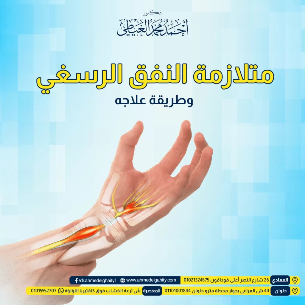 متلازمة النفق الرسغي وطريقة علاجها