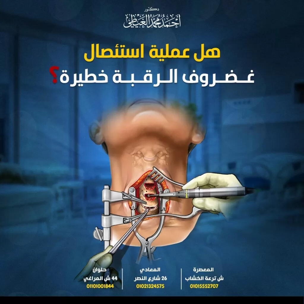 هل عملية استئصال غضروف الرقبة خطيرة؟ يعاني بعض المرضى من حالات الانزلاق الغضروفي العنقي الشديدة و الغير مستجيبة للعلاج بالأدوية أو التقنيات الغير جراحية، مما يجعل عملية استئصال غضروف الرقبة أمر ضروري ومُلح للتخلص من الألم من خلال إزالة القرص التالف لتخفيف ضغط النخاع الشوكي أو جذر العصب وتعد أحد أشكال تخفيف الضغط الجراحي، و يُطلق على ذلك الإجراء أيضًا إزالة ضغط العنق الأمامي. اذًا هل عملية استئصال غضروف الرقبة خطيرة؟ سيجيب الدكتور أحمد الغيطي أفضل استشاري جراحة العمود الفقري. احجز الآن مع دكتور أحمد الغيطي من هنا جدول المحتويات عملية استئصال غضروف الرقبة الأمامي والاندماج للاستفسارات والحجز بعيادات دكتور أحمد الغيطي: عملية استئصال غضروف الرقبة الأمامي والاندماج Anterior cervical discectomy and fusion (ACDF) هي عبارة عن استئصال القرص التالف الأمامي وتخفيف الضغط الواقع على جذر العصب أو الحبل الشوكي، وبالتالي تخفيف الألم الناتج عن ذلك الضغط لمستوى واحد من خلال إزالة قرص واحد ، أو أكثر من العمود الفقري العنقي. كما يتم اللجوء إلى عملية استئصال غضروف الرقبة لإزالة النتوءات العظمية الناتجة عن التهاب المفاصل. والتخفيف من الأعراض الناجمة عن تضيق العمود الفقري العنقي. ويتم ذلك على مرحلتين: استئصال القرص العنقي الأمامي: تتم في الجزء الأمامي من العمود الفقري العنقي من خلال إزالة القرص من بين عظمتين فقريتين. الاندماج: وهي عبارة عن جراحة دمج لتثبيت جزء العنق من خلال غرس جزء عظمي في نفس مكان القرص الأصلي لتحقيق الاستقرار والقوة لمنطقة الرقبة، وتتم تلك الجراحة في في نفس وقت عملية استئصال القرص. كيف يتم استئصال غضروف الرقبة الأمامي؟ يتم استئصال القرص التالف من الجزء الأمامي للعمود الفقري عبر منطقة الحلق من خلال تحريك عضلات الرقبة والقصبة الهوائية والمريء جانباً. يتم ذلك بشكل أكثر سهولة من الجزء الخلفي للرقبة ودون الإضرار بالحبل الشوكي والأعصاب الشوكية، وعضلات الرقبة. بعد إزالة القرص ، تتكون مساحة فارغة بين الفقرات العظمية، لذلك يتم دمج طعم عظمي فاصل لسد ذلك الفراغ ومنع الفقرات من الانهيار والاحتكاك ببعضها البعض. تتم الجراحة على 7 مراحل وتستمر حتى ثلاث ساعات وتشمل: تحضير المريض حيث يتم إدخاله إلى غرفة العمليات والاستلقاء على طاولة الجراحة. يتم تخدير المريض كلياً، ثم تنظيف منطقة الرقبة وتهيئتها. عمل شق جراحي يتم عمل شق في الجلد بطول 2 بوصة على الجانب الأيمن أو الأيسر من الرقبة، بحيث يقوم الجراح بعمل نفق للوصول إلى العمود الفقري عن طريق تحريك عضلات الرقبة جانبًا وسحب القصبة الهوائية والمريء والشرايين. يتم رفع العضلات الداعمة للجزء الأمامي من العمود الفقري ووضعها جانبًا حتى يسهل للجراح رؤية الفقرات العظمية والأقراص بوضوح. تحديد موقع القرص التالف يتم ذلك بواسطة المنظار الفلوري، وهو عبارة عن أشعة سينية متخصصة. يقوم الجراح بتمرير إبرة رفيعة في القرص لتحديد الفقرة والقرص المصاب، ثم يقوم بإبعاد عظام الفقرات الموجودة أعلى وأسفل القرص التالف بواسطة أداة خاصة. إزالة القرص التالف يقوم الجراح بقطع الجدار الخارجي للقرص، واستئصال حوالي ثلثي القرص بواسطة أدوات إمساك صغيرة، ثم يقوم بإزالة بقية القرص بالاستعانة بـ مجهر جراحي لرؤية مكانه تحديداً. يتم إزالة الرباط الذي يمر خلف الفقرات للوصول إلى القناة الشوكية، وإزالة أي مادة قرصية تضغط على الأعصاب الشوكية. فك ضغط العصب يتم ذلك من خلال إزالة النتوءات العظمية الضاغطة على جذر العصب. يليه إجراء بضع الثقبة، من خلال تكبير الثقبة التي يخرج من خلالها العصب الفقري، وذلك لتوفير مساحة أكبر للأعصاب تتيح لها الخروج من القناة الشوكية براحة ويتم ذلك الإجراء بواسطة المثقاب. تحضير الانصهار العظمي يتم ذلك بواسطة المثقاب، حيث يتم عمل مساحة حول القرص المفتوح في الأعلى والأسفل عن طريق إزالة الطبقة القشرية الخارجية من العظام، وكشف العظم الإسفنجي الغني بالدم بالداخل. وأخذ طعم عظمي من الفخذ لسد الفراغ بين الفقرات، حيث قد يقوم الجراح بأخذه من منطقة الفخذ عن طريق إجراء شق في الجلد والعضلات فوق قمة عظم الفخذ. والقطع من الطبقة الخارجية (العظم القشري) إلى الطبقة الداخلية (العظم الإسفنجي) والتي تحتوي الطبقة على الخلايا والبروتينات التي تدخل في نمو العظام. يليه تمام الاندماج عن طريق ملء الفراغات ببقايا نشارة العظام التي تحتوي على خلايا وبروتينات تنمو في العظام. يتم تقوية ذلك الطعم العظمي بواسطة لوحة معدنية مثبتة في الفقرات لتوفير الثبات أثناء الاندماج، ثم يتم أخذ صورة بالأشعة السينية للتحقق من الوضع. إغلاق الشق عن طريق خياطة شقوق العضلات والجلد معًا، ووضع شريط لاصق مخصص عبر الشق. هل عملية استئصال غضروف الرقبة خطيرة؟ هل عملية استئصال غضروف الرقبة خطيرة؟ كما هو الحال في جميع الجراحات عملية استئصال غضروف الرقبة خطيرة وتوجد نسبة من الخطورة، لذلك يجب التأكد من مراعاة جميع المخاطر والفوائد قبل اتخاذ قرار الجراحة ومناقشة الأمر مع الطبيب المعالج وأن الوضع بالفعل يستحق الاختيار الجراحي. وذلك لحقيقة أن معظم الأقراص المنفتقة تلتئم بعد بضعة أشهر من العلاج غير الجراحي وأن 10 ٪ فقط من الأشخاص الذين يعانون من مشاكل غضروف الرقبة ودرجة شديدة من الألم بعد 6 أسابيع من العلاج يلجأون إلى قرار الجراحة. يجب أن يقوم الجراح بمناقشة مخاطر وفوائد أنواع مواد ترقيع العظام، حيث يعتبر Autograft هو أفضل خيار للدمج والشفاء السريع. ولكن يعد شق الفخذ من الإجراءات الجراحية المؤلمة والذي قد يتسبب في حدوث مضاعفات أخرى تضر بالمريض. لذلك يتم اللجوء إلى Allograft (بنك العظام) الذي أثبت فعاليته في عمليات الدمج الروتينية من المستوى الأول والثاني لدى غير المدخنين. أما بالنسبة للمخاطر الناتجة عن عملية الاستئصال فنجدها تتمثل في المضاعفات العامة لأي عملية جراحية مثل النزيف، والعدوى، والجلطات الدموية نتيجة تجلط الأوردة الدموية العميقة، ونتائج التخدير. كما توجد احتمالات لحدوث بعض المضاعفات نتيجة دمج الفقرات بجانب استئصال القرص، وتشمل: بحة في الصوت وصعوبة البلع يحدث ذلك نتيجة تأثر العصب الحنجري الراجع المتحكم في الأحبال الصوتية أثناء الجراحة، والذي قد يحتاج إلى عدة أشهر للتعافي. ولكن في بعض الحالات النادرة تستمر تلك المشكلة لفترة أطول وتحتاج إلى استشارة أخصائي أنف وأذن وحنجرة لوضع العلاج المناسب للحالة. عدم اندماج الفقرات يحدث ذلك بسبب بعض العوامل التي تمنع التئام العظام بشكل كامل التدخين، وهشاشة العظام، والسمنة، وسوء التغذية. ولكن يعد التدخين هو العامل الأكبر الذي يمكن أن يمنع حدوث الاندماج التام باعتبار النيكوتين مادة مثبطة لنمو خلايا العظام. كسر الأجهزة والمقصود بالأجهزة هنا هو المسامير والألواح المعدنية المستخدمة لتثبيت العمود الفقري بسبب تحرك الجهاز أو انكساره قبل تمام الاندماج. وفي حالة حدوث ذلك، يخضع المريض إلى عملية جراحية أخرى لإصلاح أو استبدال الأجهزة. انتقال العظام وهي من الحالات النادرة التي تصيب 1-2% من المرضى نتيجة تحرك الطعم العظمي من الموضع الصحيح بين الفقرات بعد إجراء الجراحة بوقت قصير. قد يحدث ذلك عند دمج مستويات متعددة من الفقرات ، أو عدم استخدام الألواح والمسامير المثبتة، وفي تلك الحالة تكون الجراحة الثانية ضرورية. حدوث مشاكل في المنطقة المجاورة حيث يتسبب الاندماج في زيادة الضغط على الأقراص والعظام الموجودة أعلى أو أسفل الانصهار، مما قد يؤدي في النهاية إلى تدهور المناطق المجاورة والشعور بالألم. تلف الأعصاب قد تتسبب عملية استئصال غضروف الرقبة في إتلاف الأعصاب أو النخاع الشوكي. مما قد يسبب الخدر أو الشلل بجانب استمرار الشعور بالألم نتيجة تلف الأعصاب. نتائج عملية استئصال غضروف الرقبة الخطيرة هل عملية استئصال غضروف الرقبة خطيرة؟لان الانزلاق الغضروفي العنقي الشديدة و الغير مستجيبة للعلاج بالأدوية أو التقنيات الغير جراحية، مما يجعل عملية استئصال غضروف الرقبة أمر ضروري ومُلح للتخلص من الألم من خلال إزالة القرص التالف لتخفيف ضغط النخاع الشوكي أو جذر العصب وتعد أحد أشكال تخفيف الضغط الجراحي، و يُطلق على ذلك الإجراء أيضًا إزالة ضغط العنق الأمامي. اذًا هل عملية استئصال غضروف الرقبة خطيرة؟ سيجيب الدكتور أحمد الغيطي أفضل استشاري جراحة العمود الفقري. جدول المحتوياتعملية استئصال غضروف الرقبة الأمامي والاندماج للاستفسارات والحجز بعيادات دكتور أحمد الغيطي: عملية استئصال غضروف الرقبة الأمامي والاندماج Anterior cervical discectomy and fusion (ACDF) هي عبارة عن استئصال القرص التالف الأمامي وتخفيف الضغط الواقع على جذر العصب أو الحبل الشوكي وبالتالي تخفيف الألم الناتج عن ذلك الضغط لمستوى واحد من خلال إزالة قرص واحد ، أو أكثر من العمود الفقري العنقي. كما يتم اللجوء إلى عملية استئصال غضروف الرقبة لإزالة النتوءات العظمية الناتجة عن التهاب المفاصل والتخفيف من الأعراض الناجمة عن تضيق العمود الفقري العنقي. ويتم ذلك على مرحلتين: استئصال القرص العنقي الأمامي: تتم في الجزء الأمامي من العمود الفقري العنقي من خلال إزالة القرص من بين عظمتين فقريتين. الاندماج: وهي عبارة عن جراحة دمج لتثبيت جزء العنق من خلال غرس جزء عظمي في نفس مكان القرص الأصلي لتحقيق الاستقرار والقوة لمنطقة الرقبة، وتتم تلك الجراحة في في نفس وقت عملية استئصال القرص. كيف يتم استئصال غضروف الرقبة الأمامي؟ يتم استئصال القرص التالف من الجزء الأمامي للعمود الفقري عبر منطقة الحلق من خلال تحريك عضلات الرقبة والقصبة الهوائية والمريء جانباً، ويتم ذلك بشكل أكثر سهولة من الجزء الخلفي للرقبة ودون الإضرار بالحبل الشوكي والأعصاب الشوكية، وعضلات الرقبة. بعد إزالة القرص ، تتكون مساحة فارغة بين الفقرات العظمية، لذلك يتم دمج طعم عظمي فاصل لسد ذلك الفراغ ومنع الفقرات من الانهيار والاحتكاك ببعضها البعض. تتم الجراحة على 7 مراحل وتستمر حتى ثلاث ساعات وتشمل: تحضير المريض حيث يتم إدخاله إلى غرفة العمليات والاستلقاء على طاولة الجراحة. يتم تخدير المريض كلياً، ثم تنظيف منطقة الرقبة وتهيئتها. عمل شق جراحي يتم عمل شق في الجلد بطول 2 بوصة على الجانب الأيمن أو الأيسر من الرقبة، بحيث يقوم الجراح بعمل نفق للوصول إلى العمود الفقري عن طريق تحريك عضلات الرقبة جانبًا وسحب القصبة الهوائية والمريء والشرايين. يتم رفع العضلات الداعمة للجزء الأمامي من العمود الفقري ووضعها جانبًا حتى يسهل للجراح رؤية الفقرات العظمية والأقراص بوضوح. تحديد موقع القرص التالف يتم ذلك بواسطة المنظار الفلوري، وهو عبارة عن أشعة سينية متخصصة. يقوم الجراح بتمرير إبرة رفيعة في القرص لتحديد الفقرة والقرص المصاب، ثم يقوم بإبعاد عظام الفقرات الموجودة أعلى وأسفل القرص التالف بواسطة أداة خاصة. إزالة القرص التالف يقوم الجراح بقطع الجدار الخارجي للقرص، واستئصال حوالي ثلثي القرص بواسطة أدوات إمساك صغيرة، ثم يقوم بإزالة بقية القرص بالاستعانة بـ مجهر جراحي لرؤية مكانه تحديداً. يتم إزالة الرباط الذي يمر خلف الفقرات للوصول إلى القناة الشوكية، وإزالة أي مادة قرصية تضغط على الأعصاب الشوكية. فك ضغط العصب يتم ذلك من خلال إزالة النتوءات العظمية الضاغطة على جذر العصب. يليه إجراء بضع الثقبة، من خلال تكبير الثقبة التي يخرج من خلالها العصب الفقري، وذلك لتوفير مساحة أكبر للأعصاب تتيح لها الخروج من القناة الشوكية براحة ويتم ذلك الإجراء بواسطة المثقاب. تحضير الانصهار العظمي يتم ذلك بواسطة المثقاب، حيث يتم عمل مساحة حول القرص المفتوح في الأعلى والأسفل عن طريق إزالة الطبقة القشرية الخارجية من العظام، وكشف العظم الإسفنجي الغني بالدم بالداخل. وأخذ طعم عظمي من الفخذ لسد الفراغ بين الفقرات، حيث قد يقوم الجراح بأخذه من منطقة الفخذ عن طريق إجراء شق في الجلد والعضلات فوق قمة عظم الفخذ، والقطع من الطبقة الخارجية (العظم القشري) إلى الطبقة الداخلية (العظم الإسفنجي) والتي تحتوي الطبقة على الخلايا والبروتينات التي تدخل في نمو العظام. يليه تمام الاندماج عن طريق ملء الفراغات ببقايا نشارة العظام التي تحتوي على خلايا وبروتينات تنمو في العظام. يتم تقوية ذلك الطعم العظمي بواسطة لوحة معدنية مثبتة في الفقرات لتوفير الثبات أثناء الاندماج، ثم يتم أخذ صورة بالأشعة السينية للتحقق من الوضع. إغلاق الشق عن طريق خياطة شقوق العضلات والجلد معًا، ووضع شريط لاصق مخصص عبر الشق. هل عملية استئصال غضروف الرقبة خطيرة؟ كما هو الحال في جميع الجراحات، توجد نسبة من الخطورة، لذلك يجب التأكد من مراعاة جميع المخاطر والفوائد قبل اتخاذ قرار الجراحة ومناقشة الأمر مع الطبيب المعالج وأن الوضع بالفعل يستحق الاختيار الجراحي، وذلك لحقيقة أن معظم الأقراص المنفتقة تلتئم بعد بضعة أشهر من العلاج غير الجراحي وأن 10 ٪ فقط من الأشخاص الذين يعانون من مشاكل غضروف الرقبة ودرجة شديدة من الألم بعد 6 أسابيع من العلاج يلجأون إلى قرار الجراحة. يجب أن يقوم الجراح بمناقشة مخاطر وفوائد أنواع مواد ترقيع العظام، حيث يعتبر Autograft هو أفضل خيار للدمج والشفاء السريع ، ولكن يعد شق الفخذ من الإجراءات الجراحية المؤلمة والذي قد يتسبب في حدوث مضاعفات أخرى تضر بالمريض. لذلك يتم اللجوء إلى Allograft (بنك العظام) الذي أثبت فعاليته في عمليات الدمج الروتينية من المستوى الأول والثاني لدى غير المدخنين. أما بالنسبة للمخاطر الناتجة عن عملية الاستئصال فنجدها تتمثل في المضاعفات العامة لأي عملية جراحية مثل النزيف، والعدوى، والجلطات الدموية نتيجة تجلط الأوردة الدموية العميقة، ونتائج التخدير. كما توجد احتمالات لحدوث بعض المضاعفات نتيجة دمج الفقرات بجانب استئصال القرص، وتشمل: بحة في الصوت وصعوبة البلع يحدث ذلك نتيجة تأثر العصب الحنجري الراجع المتحكم في الأحبال الصوتية أثناء الجراحة، والذي قد يحتاج إلى عدة أشهر للتعافي. ولكن في بعض الحالات النادرة تستمر تلك المشكلة لفترة أطول وتحتاج إلى استشارة أخصائي أنف وأذن وحنجرة لوضع العلاج المناسب للحالة. عدم اندماج الفقرات يحدث ذلك بسبب بعض العوامل التي تمنع التئام العظام بشكل كامل التدخين، وهشاشة العظام، والسمنة، وسوء التغذية. ولكن يعد التدخين هو العامل الأكبر الذي يمكن أن يمنع حدوث الاندماج التام باعتبار النيكوتين مادة مثبطة لنمو خلايا العظام. كسر الأجهزة والمقصود بالأجهزة هنا هو المسامير والألواح المعدنية المستخدمة لتثبيت العمود الفقري بسبب تحرك الجهاز أو انكساره قبل تمام الاندماج. وفي حالة حدوث ذلك، يخضع المريض إلى عملية جراحية أخرى لإصلاح أو استبدال الأجهزة. انتقال العظام وهي من الحالات النادرة التي تصيب 1-2% من المرضى نتيجة تحرك الطعم العظمي من الموضع الصحيح بين الفقرات بعد إجراء الجراحة بوقت قصير. قد يحدث ذلك عند دمج مستويات متعددة من الفقرات ، أو عدم استخدام الألواح والمسامير المثبتة، وفي تلك الحالة تكون الجراحة الثانية ضرورية. حدوث مشاكل في المنطقة المجاورة حيث يتسبب الاندماج في زيادة الضغط على الأقراص والعظام الموجودة أعلى أو أسفل الانصهار، مما قد يؤدي في النهاية إلى تدهور المناطق المجاورة والشعور بالألم. تلف الأعصاب قد تتسبب عملية استئصال غضروف الرقبة في إتلاف الأعصاب أو النخاع الشوكي، مما قد يسبب الخدر أو الشلل بجانب استمرار الشعور بالألم نتيجة تلف الأعصاب. نتائج عملية استئصال غضروف الرقبة تصل نسب نجاح عملية استئصال القرص العنقي الأمامي في تخفيف ألم الذراع إلى 92 - 100٪ ، ولكن قد يستمر ضعف وخدر الذراع من أسابيع إلى شهور. بينما تصل النسبة إلى 73 - 83٪ في تخفيف ألم الرقبة. وبذلك، يستفيد الأشخاص الذين يعانون من آلام الذراع من عملية استئصال غضروف الرقبة الأمامي ACDF بشكل أكبر من المرضى الذين يعانون من آلام الرقبة. بينما تختلف نتائج اندماج العمود الفقري اعتمادًا على التقنية المستخدمة والحالة الصحية للمريض وخاصة إذا كان مدخن. فنجد أن 67% من الأشخاص الذين خضعوا لـ ACD (بدون طعم عظمي) حققوا الاندماج بشكل طبيعي، ولكن مع حدوث انحناء غير طبيعي للعمود الفقري (حداب) مقارنة بالتقنيات الأخرى. بينما حقق 93% من المرضى الذين خضعوا لـ ACDF مع زرع العظام الاندماج بشكل جيد، أما الأشخاص الذين خضعوا لـ ACDF مع وضع الطعم العظمي والألواح والمسامير المثبتة حققوا اندماجًا بنسبة 100%. الخلاصة تعد عملية استئصال غضروف الرقبة خطيرة مثلها مثل باقي الجراحات المختلفة، لذلك يجب مناقشة جميع الخيارات العلاجية الأخرى مع الطبيب المعالج واختيار أكثرها أماناً للحالة والتي توفر المزيد من الشعور بالراحة وتخفيف الألم. من هو أفضل دكتور عمود فقري لعلاج غضروف الرقبة بالجراحة؟ أفضل وأحسن دكتورعمود فقري وتدخل محدود يقوم بعلاج غضروف الرقبة بالجراحة هو جراح العمود الفقري والتدخل المحدود الذي تدرب على فروع جراحات العمود الفقري متناهية الدقة والميكروسكوبية, سواء باستخدام الميكروسكوب الجراحي أو باستخدام المنظار. كما يجب أن يكون متمكنا من دراسة التاريخ المرضي للحالة بدقة والتأكد من نوع الورم الموجود لدى المريض. ويقوم دكتور أحمد الغيطي باجراء كافة جراحاتالعمود الفقري والتدخل المحدود سواء ميكروسكوبيا أو بالمنظار المخي لعلاجغضروف الرقبة جراحيا. عيادة دكتور أحمد الغيطي استشاري جراحة العمود الفقري والتدخل المحدود اقرأ أيضا: (مصادر) غضروف الرقبة والصداع: أعراضه، أسبابه، علاجه الم الرقبة من الخلف: الأسباب والعلاج الغضروف القطني وعرق النسا دكتور أحمد الغيطي نحرص على اتباع الخطوات اللازمة للتعرف على حالتك وبناء خطة علاجية فعالة. اضغط هنا لحجز موعد في عيادة دكتور أحمد الغيطي لعملية استئصال غضروف الرقبة الخطيرة دكتور أحمد الغيطي استشاري جراحة المخ والأعصاب والعمود الفقري. استشاري القسطرة المخية التداخلية وجراحات المخ والأعصاب الوظيفية وجراحة الصرع. دكتوراه جراحة المخ والأعصاب – كلية طب القصر العيني – جامعة القاهرة. زميل البورد الأوربي للجراحات العصبية (FEBNS). تابعونا على صفحة الفيسبوك من هنا صفحة الفيسبوك للاستفسارات والحجز بعيادات دكتور أحمد الغيطي: عيادة المعادي: 26 شارع النصر أعلى فودافون ت/ 01021324575 وعيادة حلوان: 44 شارع المراغي بجوار هل عملية استئصال غضروف الرقبة خطيرة؟ تصل نسب نجاح عملية استئصال القرص العنقي الأمامي في تخفيف ألم الذراع إلى 92 – 100٪ . ولكن قد يستمر ضعف وخدر الذراع من أسابيع إلى شهور. بينما تصل النسبة إلى 73 – 83٪ في تخفيف ألم الرقبة. وبذلك، يستفيد الأشخاص الذين يعانون من آلام الذراع من عملية استئصال غضروف الرقبة الأمامي ACDF بشكل أكبر من المرضى الذين يعانون من آلام الرقبة. بينما تختلف نتائج اندماج العمود الفقري اعتمادًا على التقنية المستخدمة والحالة الصحية للمريض وخاصة إذا كان مدخن. فنجد أن 67% من الأشخاص الذين خضعوا لـ ACD (بدون طعم عظمي) حققوا الاندماج بشكل طبيعي، ولكن مع حدوث انحناء غير طبيعي للعمود الفقري (حداب) مقارنة بالتقنيات الأخرى. بينما حقق 93% من المرضى الذين خضعوا لـ ACDF مع زرع العظام الاندماج بشكل جيد. أما الأشخاص الذين خضعوا لـ ACDF مع وضع الطعم العظمي والألواح والمسامير المثبتة حققوا اندماجًا بنسبة 100%. الخلاصة تعد عملية استئصال غضروف الرقبة خطيرة مثلها مثل باقي الجراحات المختلفة، لذلك يجب مناقشة جميع الخيارات العلاجية الأخرى مع الطبيب المعالج واختيار أكثرها أماناً للحالة والتي توفر المزيد من الشعور بالراحة وتخفيف الألم. من هو أفضل دكتور عمود فقري لعلاج غضروف الرقبة بالجراحة؟ أفضل وأحسن دكتورعمود فقري وتدخل محدود يقوم بعلاج غضروف الرقبة بالجراحة هو جراح العمود الفقري والتدخل المحدود. الذي تدرب على فروع جراحات العمود الفقري متناهية الدقة والميكروسكوبية, سواء باستخدام الميكروسكوب الجراحي أو باستخدام المنظار. كما يجب أن يكون متمكنا من دراسة التاريخ المرضي للحالة بدقة والتأكد من نوع الورم الموجود لدى المريض. ويقوم دكتور أحمد الغيطي باجراء كافة جراحاتالعمود الفقري والتدخل المحدود سواء ميكروسكوبيا أو بالمنظار المخي لعلاجغضروف الرقبة جراحيا. أراء مرضى دكتور أحمد الغيطي أفضل دكتور جراحة مخ وأعصاب العمليات التي يجريها دكتور أحمد الغيطي مجموعة من صور أشعات بعض المرضى قبل وبعد اجراء تدخلات جراحية لعلاج حالتهم, قام باجراء الجراحات دكتور أحمد الغيطي. يقوم دكتور أحمد الغيطي بإجراء جراحات أورام المخ والنخاع الشوكي, أورام قاع الجمجمة, غلق التمددات الشريانية والتشوهات الشريانية الوريدية جراحيا وعن طريق القسطرة المخية التداخلية. يقوم دكتور أحمد الغيطي باجراء جراحات العمود الفقري متناهية الدقة كاستئصال الانزلاق الغضروفي العنقي والقطني بالميكروسكوب أو المنظار الجراحي. عيادة دكتور أحمد الغيطي استشاري جراحة العمود الفقري والتدخل المحدود اقرأ أيضا: (مصادر) غضروف الرقبة والصداع: أعراضه، أسبابه، علاجه الم الرقبة من الخلف: الأسباب والعلاج الغضروف القطني وعرق النسا دكتور أحمد الغيطي نحرص على اتباع الخطوات اللازمة للتعرف على حالتك وبناء خطة علاجية فعالة. اضغط هنا لحجز موعد في عيادة دكتور أحمد الغيطي لعملية استئصال غضروف الرقبة الخطيرة دكتور أحمد الغيطي لعملية استئصال غضروف الرقبة الخطيرة استشاري جراحة المخ والأعصاب والعمود الفقري. استشاري القسطرة المخية التداخلية وجراحات المخ والأعصاب الوظيفية وجراحة الصرع. دكتوراه جراحة المخ والأعصاب – كلية طب القصر العيني – جامعة القاهرة. زميل البورد الأوربي للجراحات العصبية (FEBNS). تابعونا على صفحة الفيسبوك من هنا صفحة الفيسبوك للاستفسارات والحجز بعيادات دكتور أحمد الغيطي: عيادة المعادي: 26 شارع النصر أعلى فودافون ت/ 01021324575 وعيادة حلوان: 44 شارع المراغي بجوار محطة مترو حلوان ت: 01101001844 عيادة المعصرة: ش ترعة الخشاب فوق كافيتيريا اللؤلؤة ت/ 01015552707 احجز الآن مع دكتور أحمد الغيطي من هنا تصفّح المقالات → المقالة السابقة المقالة التالية ← مواضيع متعلقة ضيق القناة العنقية العصبية الشوكية ضيق القناة العنقية العصبية الشوكية علاج اعتلال النخاع الشوكي علاج اعتلال النخاع الشوكي. اترك تعليقاً Logged in as AHMED ELGHITY. Edit your profile. Log out? الحقول الإلزامية مشار إليها بـ * اكتب هنا... اكتب هنا...