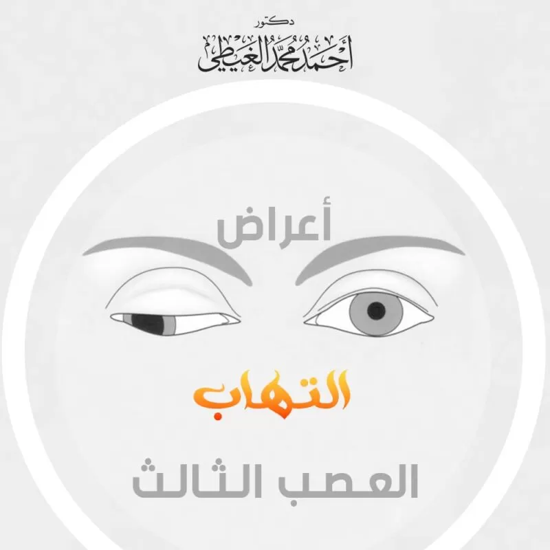 أعراض التهاب العصب الثالث أعراض التهاب العصب الثالث تبدو واضحة على صاحبها نظراً لما يعانيه من آلام شديدة في أكثر من منطقة في الوجه، حيث يعد هذا الالتهاب من ضمن الأمراض العصبية الخطيرة التي تؤثر بشكل كبير على العين وحركتها مسببة في ذلك تعرض المريض للاكتئاب والضغوطات العصبية والنفسية. وسوف نتناول في هذا المقال جميع الأعراض التي تبدو على المريض وغير ذلك من المعلومات المتعلقة بهذا الموضوع من خلال موقع دكتور أحمد الغيطي. نبذة عن التهاب العصب الثالث قبل أن نتحدث عن أعراض التهاب العصب الثالث يجب أن نعلم بعض المعلومات عنه كي نكون على وعي تام بما يقوم به من آثار وما يعانيه المريض، ولمعرفة المزيد من المعلومات عنه تابع النقاط التالية: العصب الثالث يتحكم بشكل رئيسي في 4 عضلات في العين من إجمالي 6 عضلات. يقع العصب الثالث داخل المخ. يعمل على نقل الأحاسيس التي تحدث في الوجه إلى الدماغ. يتكون العصب الثالث من ثلاث أقسام وهم، الفك السفلي والعلوي والعيون. الأقسام السابق ذكرها تربط بين الأعصاب الموجودة في الدماغ وأجزاء الوجه المختلفة. العصب الثالث يتحكم أيضاً في الانقباض المتعلق بحدقة العين وقدرتها على التركيز. عند حدوث التهاب في هذا العصب فإنه يؤثر بشكل رئيسي على الجفن والعين. زيادة الالتهاب تُعرض المصاب إلى الجفن المغلق تماماً، بالإضافة إلى انحراف العين سواء للخارج أو للأسفل. يؤثر على الوظائف المسؤولة عن العصب ولكن بدرجات مختلفة. أعراض التهاب العصب الثالث بعد أن ذكرنا بعض المعلومات عنه نستطيع الآن معرفة الأعراض التي يشعر بها مصاب التهاب العصب الثالث، ومن أبرزها ما يلي: تعرض الجفون إلى التدلي. اتساع حدقة العين وتضخمها. التعرض إلى ازدواج الرؤية. تعرض جفون العيون إلى الانغلاق بشكل تام. الإحساس بالألم الشديد وهو من أهم الأعراض التي تدل على الإصابة بالعصب الثالث للعين والذي يكون سببه نقص التروية الدموية. عدم القدرة على التحكم في العين بالطريقة التي تؤدي إلى عدم الاستجابة الطبيعية للضوء عند رؤيته. اقرأ أيضًا: الشقيقة: الأعراض والأسباب وطرق العلاج أسباب التهاب العصب الثالث أسباب التهاب العصب الثالث وراء أعراض التهاب العصب الثالث مجموعة من الأسباب والتي من بينها ما يلي: تعرض المريض إلى بعض الحوادث أهمها إصابة الرأس بشكل مباشر. التعرض إلى مرض يسمى التصلب المتعدد بالإضافة إلى الأمراض الأخرى التي من شأنها التقليل من نسبة المايلين الموجودة حول الأعصاب. إصابة الدماغ بالعدوى. التعرض للصداع النصفي الشديد. القيام بإجراء بعض العمليات الجراحية التي تتعلق بالمخ والأعصاب. إصابة الدماغ بالورم. الإصابة بالأمراض التي يكون لها تأثير سلبي على الأوعية الدموية الموجودة في الجسم منها، على سبيل المثال زيادة ضغط الدم أو مرض السكري. حدوث نزيف شديد في الأغشية المخاطية التي تعمل على تغطية الدماغ بشكل كامل. طرق تشخيص التهاب العصب الثالث يوجد العديد من الطرق التي يتبعها الطبيب المعالج من أجل تشخيص العصب الثالث ولمعرفة الأسباب التي عملت على حدوث هذا الأمر من أجل توفير العلاج المناسب الذي يتفق مع كل حالة، ومن أهم طرق التشخيص ما يلي: يقوم الطبيب المعالج في بداية الأمر بعمل الإجراءات اللازمة لمعرفة ما إذا كان هناك شخص مصاب في العائلة بهذا المرض أم لا. يطرح الطبيب على المريض بعض الأسئلة يعلم من خلالها العلامات وأعراض التهاب العصب الثالث ووجود العديد من التغيرات العصبية منها على سبيل المثال الحركات اللاإرادية أو وجود بعض التغيرات العقلية وغير ذلك من الأسئلة اللازمة للتشخيص السليم. ينبغي عمل فحص جسدي شامل للعيون ومعرفة درجة النظر وهل هناك بؤبؤ العين تستجيب بشكل مناسب للضوء أم لا؟. يجب إجراء بعض الفحوصات العصبية، حيث يقوم الطبيب بإجراء بعض الفحوصات المتعلقة باختبار رد الفعل المنعكس والقدرة على تحديد الأعراض سواء كانت ناتجة عن العصب المضغوط أو غير ذلك. الفحص بالأشعة، منها على سبيل المثال الأشعة المقطعية والرنين المغناطيسي، ويمكن الاستعانة بوسيلة أدق من هذه الأشعة وهي عمل تصوير رقمي لكافة الأوعية الدموية الموجودة بالجسم. الاستعانة بمعظم الفحوصات المخبرية والتي تتناسب مع عمر المريض طبقاً للأمراض التي يشكو منها والأعراض المتعلقة بها وبالتالي يمكنه عمل فحص دم كامل أو ما يطلق عليه CBC والقيام ببعض الاختبارات التي يمكن من خلالها معرفة الترسيب المتعلق بخلايا الدم الحمراء والتعرف على المستوى الذي يصل إليه بروتين C التفاعلي. اقرأ أيضًا: أعراض العصب الخامس علاج التهاب العصب الثالث علاج التهاب العصب الثالث يتوقف علاج هذا النوع من الالتهاب على السبب الذي عمل على حدوث تلك الإصابة حيث يوجد: العصب الثالث الخلقي الذي لا نستطيع توفير علاج له يمكن من خلاله استعادة الوظيفة الأساسية للعصب مرة ثانية. العصب الثالث المكتسب والذي يمكن توفير علاج نستطيع من خلاله تقليل الضغط على العصب. التهاب العصب الثالث الشديد يمكن توفير بعض العلاجات له منها ما يلي: ارتداء النظارات بعد أن يتعرض المريض إلى التهاب العصب الثالث ففي هذا الوقت ينتظر الطبيب مدة تصل إلى 6 شهور يمكن من خلالها معرفة ما إذا كان الالتهاب سوف يختفي نهائياً دون التأثير على المريض أم لا، وفي تلك الفترة يقوم بوصف نظارة مناسبة له يمكن من خلالها التقليل من الرؤية المزدوجة والقدرة على الرؤية بشكل واضح. الجراحة تفيد جراحة العضلات المتعلقة بالعين على إعادة المستوى الأساسي العين بالشكل الذي تكون العين فيه مستقيمة في حالة النظر إلى الأمام، وهناك معظم الحالات التي يحتاج فيها تطبيق ذلك مجموعة من الإجراءات وكيفية الوقاية من التهاب العصب الثالث. العلاج بالأدوية ويحدث من خلال مراقبة المريض في بداية الأمر ووصف بعض العلاجات للعين حتى لا تتعرض إلى الرؤية المزدوجة، كما يستطيع المريض استعمال معظم العوامل الخاصة باسترخاء العضلات منها على سبيل المثال باكلوفين، ويتناول المريض معظم المضادات الحيوية إذا لم يشعر بألم. العلاج الطبيعي ويكون الهدف منه المحافظة على العين وعدم زيادة الحالة سوءً، حيث يستطيع المريض في هذه الحالة القيام بما يلي: استخدام رقعة يتم وضعها على المنطقة المصابة التي توجد في العين. استعمال العدسات اللاصقة غير الشفافة. يمكن كذلك الحقن باستخدام البوتوكس. اقرأ أيضًا: اعوجاج العمود الفقري عند الأطفال الوقاية من التهاب العصب الثالث بعض الأشخاص قد أصيبت بهذا الالتهاب بالفعل وهناك من يرغب في توفير الوقاية من أجل عدم تعرضه لهذه المشكلة، ولكن ينبغي أن نشير إلى أنه لا تستطيع توفير الوقاية الكاملة في معظم الحالات لأن هذا الأمر واقع بالفعل، ولكن يمكننا أن نذكر معظم التدابير الوقائية التي يمكن أن تسيطر عليها بسهولة لعدم حدوث التهاب العصب الثالث ومنها التالي: الابتعاد عن التدخين بشكل نهائي وكافة المنتجات التي يوجد فيها مادة التبغ. الابتعاد عن كافة الأنشطة التي تشكل خطورة كبيرة على الرأس حتى وإن كانت ممارسة بعض التمارين الرياضية التي تتصف بالشدة. الاهتمام بتناول العلاج المتعلق بالأمراض المزمنة والتي على رأسه مرض ارتفاع الضغط أو مرض السكري. يجب الذهاب إلى الطبيب بشكل مستمر من أجل الاطمئنان على مستوى السكر الموجود في الدم بالإضافة إلى الاطمئنان على مستوى ضغط الدم وأنه في الوضع الطبيعي. العصب الثالث له دور لا غنى عنه في جسم الإنسان لأنه المتحكم الرئيسي في العضلات ونقل جميع الأحاسيس، كما أن له دور كبير في انقباض حدقة العين واستطاعتها على التركيز ولذلك عندما تلاحظ وجود أي عرض من أعراض التهاب العصب الثالث لابد من زيارة الطبيب وعدم تجاهل هذا العرض. مراجع داخلية: اعراض التهاب الاعصاب وعلاجه