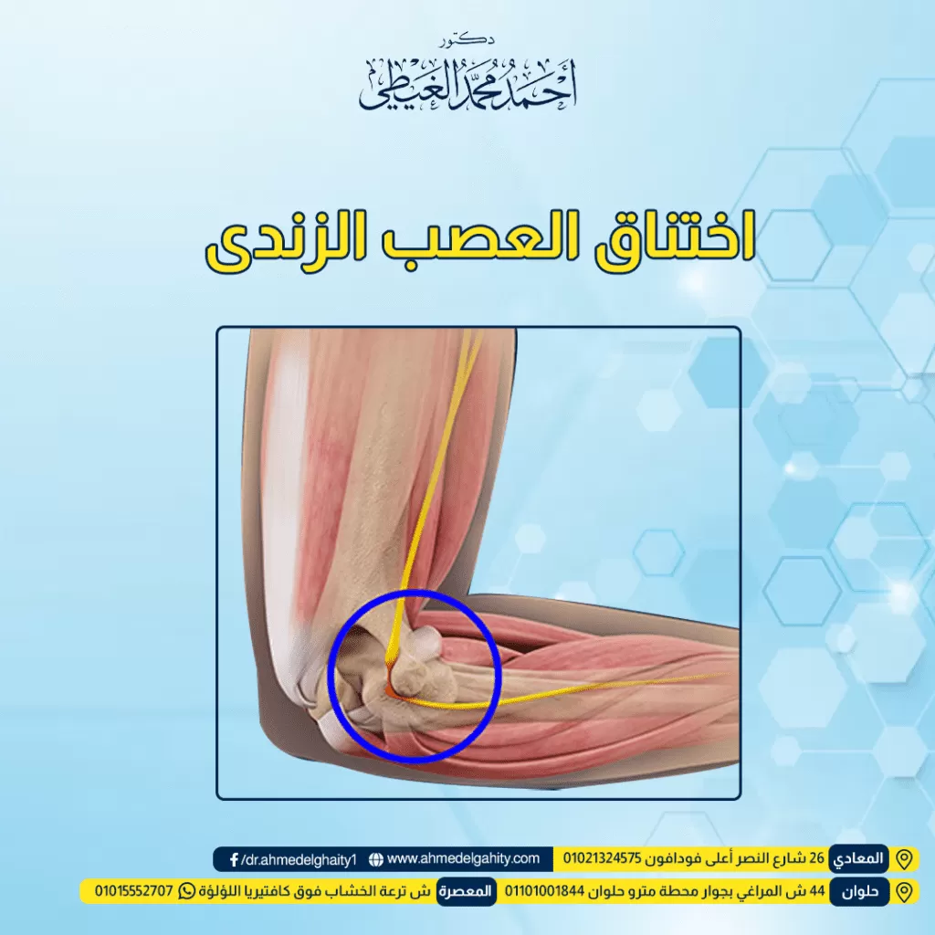 اختناق العصب الزندى متلازمة النفق المرفقي