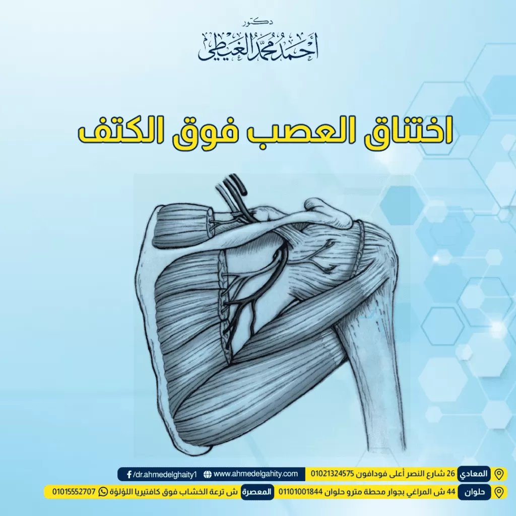 اختناق العصب فوق الكتف اعراضه واسبابه وعلاجه